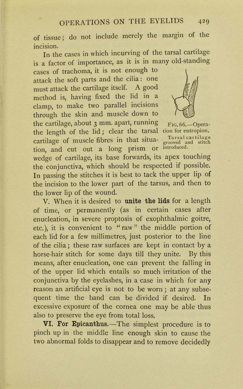 of tissue; do not include merely the margin of the incision. In the cases in which incurving of the tarsal cartilage is a factor of importance, as it is in many old-standing cases of trachoma, it is not enough to attack the soft parts and the cilia: one must attack the cartilage itself. A good method is, having fixed the lid in a clamp, to make two parallel incisions through the skin and muscle down to the cartilage, about 3 mm. apart, running fig.66.—Opera- the length of the lid; clear the tarsal tion for entropion. cartilage of muscle fibres in that situa- gJ0”sdal‘,drtisut?5 tion, and cut out a long prism or introduced, wedge of cartilage, its base forwards, its apex touching the conjunctiva, which should be respected if possible. In passing the stitches it is best to tack the upper lip of the incision to the lower part of the tarsus, and then to the lower lip of the wound. V. When it is desired to unite the lids for a length of time, or permanently (as in certain cases after enucleation, in severe proptosis of exophthalmic goitre, etc.), it is convenient to “raw” the middle portion of each lid for a few millimetres, just posterior to the line of the cilia; these raw surfaces are kept in contact by a horse-hair stitch for some days till they unite. By this means, after enucleation, one can prevent the falling in of the upper lid which entails so much irritation of the conjunctiva by the eyelashes, in a case in which for any reason an artificial eye is not to be worn ; at any subse- quent time the band can be divided if desired. In excessive exposure of the cornea one may be able thus also to preserve the eye from total loss. VI. For Epicanthus.—The simplest procedure is to pinch up in the middle line enough skin to cause the two abnormal folds to disappear and to remove decidedly