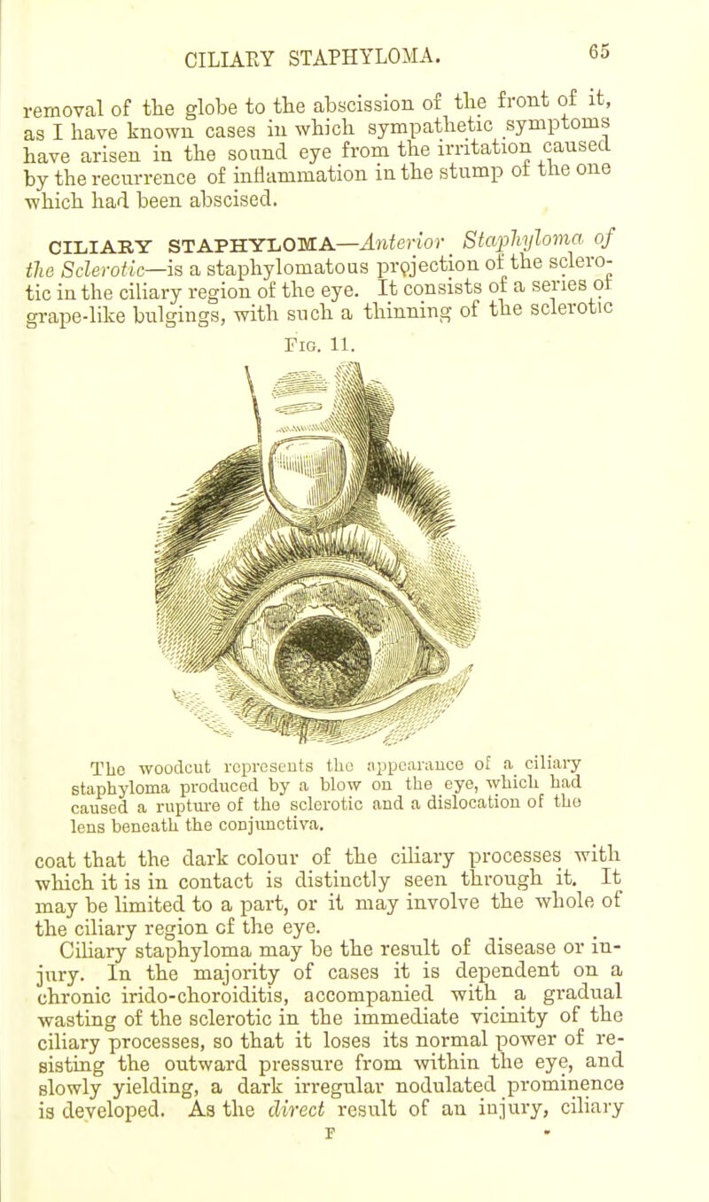 CILIAEY STAPHYLOMA. removal of the globe to tlie abscission of tbe front of it, as I have known cases in wbicli sympathetic symptoms have arisen in the sound eye from the irritation caused by the recurrence of inflammation in the stump ot the one ■which had been abscised. CILIARY STAPHYLOMA—^wierior Staphyloma of the Sclerotic—is a staphylomatous projection of the sclero- tic in the ciliary region of the eye. It consists of a series ot grape-like bulgings, with snch a thinning of the sclerotic Fig. 11. Tlie woodcut roprcseuts the aiipcanmce of a ciliai-y staphyloma produced by a blow on the eye, which had caused a ruptm-e of the sclerotic and a dislocation of the lens beneath the conjunctiva. coat that the dark colour of the ciliary processes with which it is in contact is distinctly seen through it. It may be limited to a part, or it may involve the whole of the ciliary region of the eye. CiHary staphyloma may be the result of disease or in- jury. In the majority of cases it is dependent on a chronic irido-choroiditis, accompanied with a gradual wasting of the sclerotic in the immediate vicinity of the ciliary processes, so that it loses its normal power of re- sisting the outward pressure from within the eye, and slowly yielding, a dark irregular nodulated prominence is developed. Aa the direct result of an injury, cihary