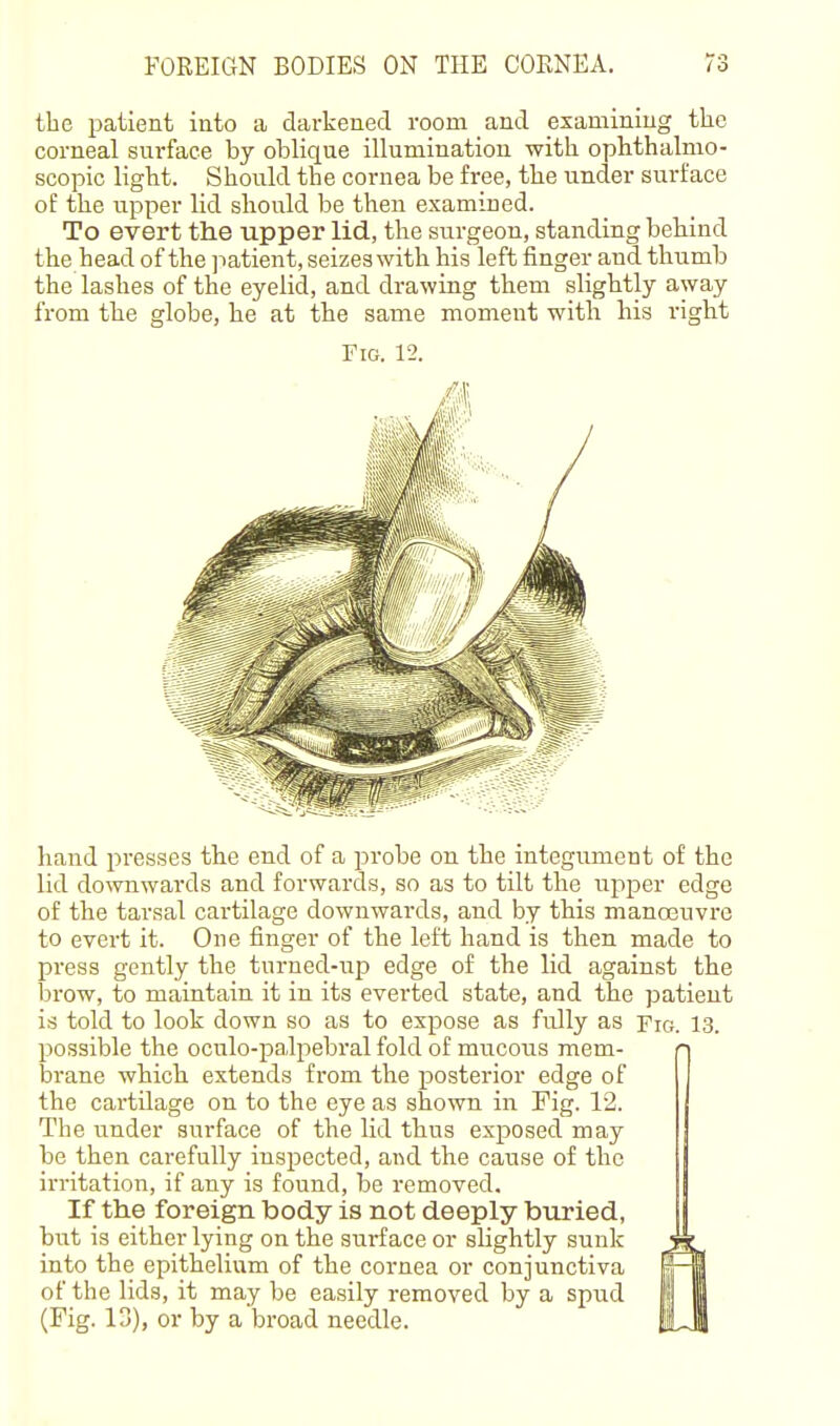 the patient into a darkened room and examining the corneal snrface by oblique illumination with ophthalmo- scopic light. Should the cornea be free, the under surface of the upper lid should be then examined. To evert the upper lid, the surgeon, standing behind the head of the ]iatient, seizes with his left finger and thumb the lashes of the eyelid, and drawing them slightly away from the globe, he at the same moment with his right Fig. 12. hand presses the end of a probe on the integument of the lid downwards and forwards, so as to tilt the upper edge of the tarsal cartilage downwards, and by this manoeuvre to evert it. One finger of the left hand is then made to press gently the turned-iip edge of the lid against the brow, to maintain it in its everted state, and the patient is told to look down so as to expose as fully as Fic. 13. possible the oculo-palpebral fold of mucous mem- n brane which extends from the posterior edge of I the cartilage on to the eye as shown in Fig. 12. The under surface of the lid thus exposed may be then carefully inspected, and the cause of the in-itation, if any is found, be removed. If the foreign body is not deeply buried, but is either lying on the surface or slightly sunk into the epithelium of the cornea or conjunctiva of the lids, it may be easily removed by a spud (Fig. 13), or by a broad needle.