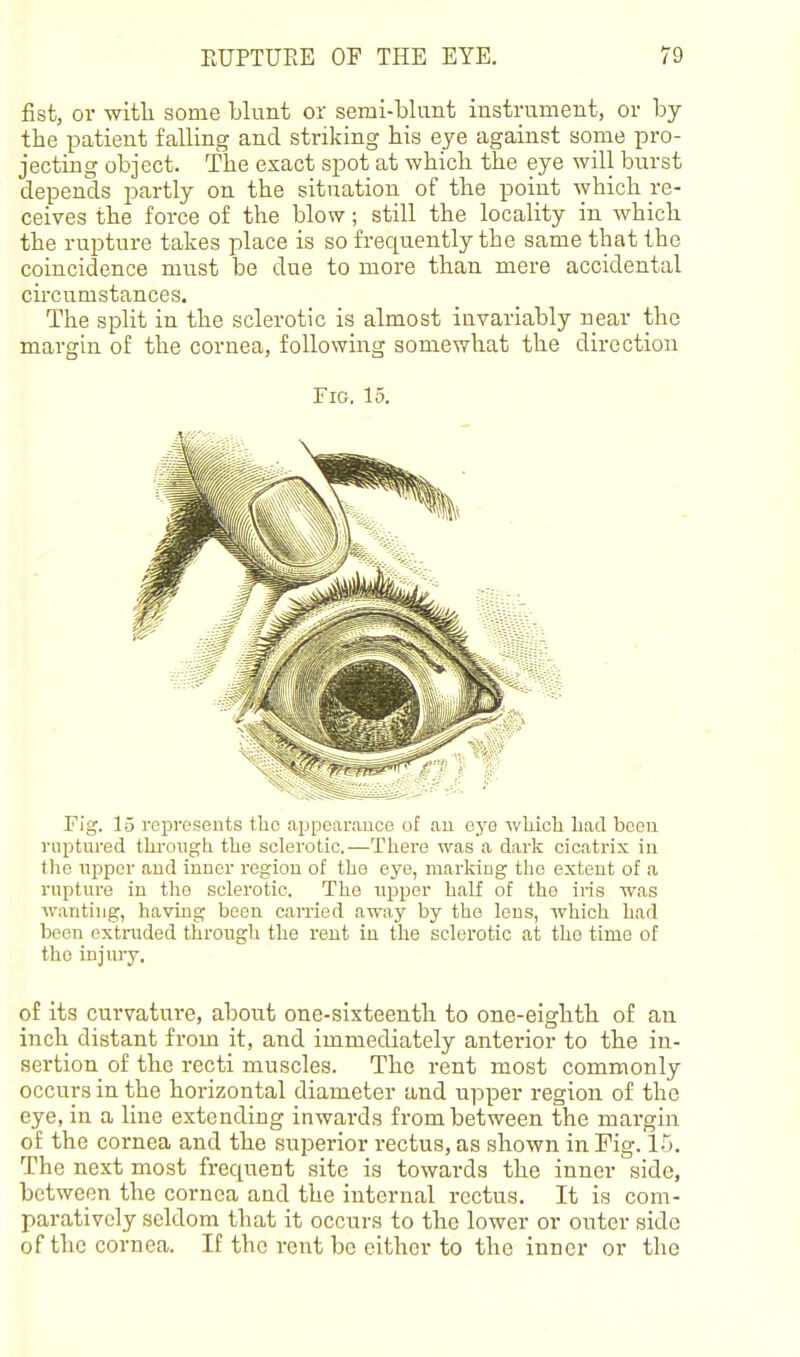 fist, 01- witli some blunt or semi-blant instrument, or by the patient falling and striking his eye against some pro- jecting object. The exact spot at which the eye will burst depends partly on the situation of the point which re- ceives the force of the blow; still the locality in which the rupture takes place is so frequently the same that the coincidence must be due to more than mere accidental circumstances. The split in the sclerotic is almost invariably near the margin of the cornea, following somewhat the direction Fig. 15. Fig. 15 represents the appearauco of au oyo which had boeu ruptured through the sclerotic.—There was a dark cicatrix in tlie upper aud inner region of tho eye, marking the extent of a rupture in the sclerotic. Tho upper half of the iris was wanting, having been carried away by the lens, which had been extruded through the rent in the sclerotic at tho time of tho injury. of its curvature, about one-sixteenth to one-eighth of an inch distant from it, and immediately anterior to the in- sertion of the recti muscles. The rent most commonly occurs in the horizontal diameter and upper region of the eye, in a line extending inwards from between the margin of the cornea and the superior rectus, as shown in Fig. 15. The next most frequent site is towards the inner side, between the cornea and the internal rectus. It is com- paratively seldom that it occurs to the lower or outer side of the cornea. If the rent be cither to the inner or tho