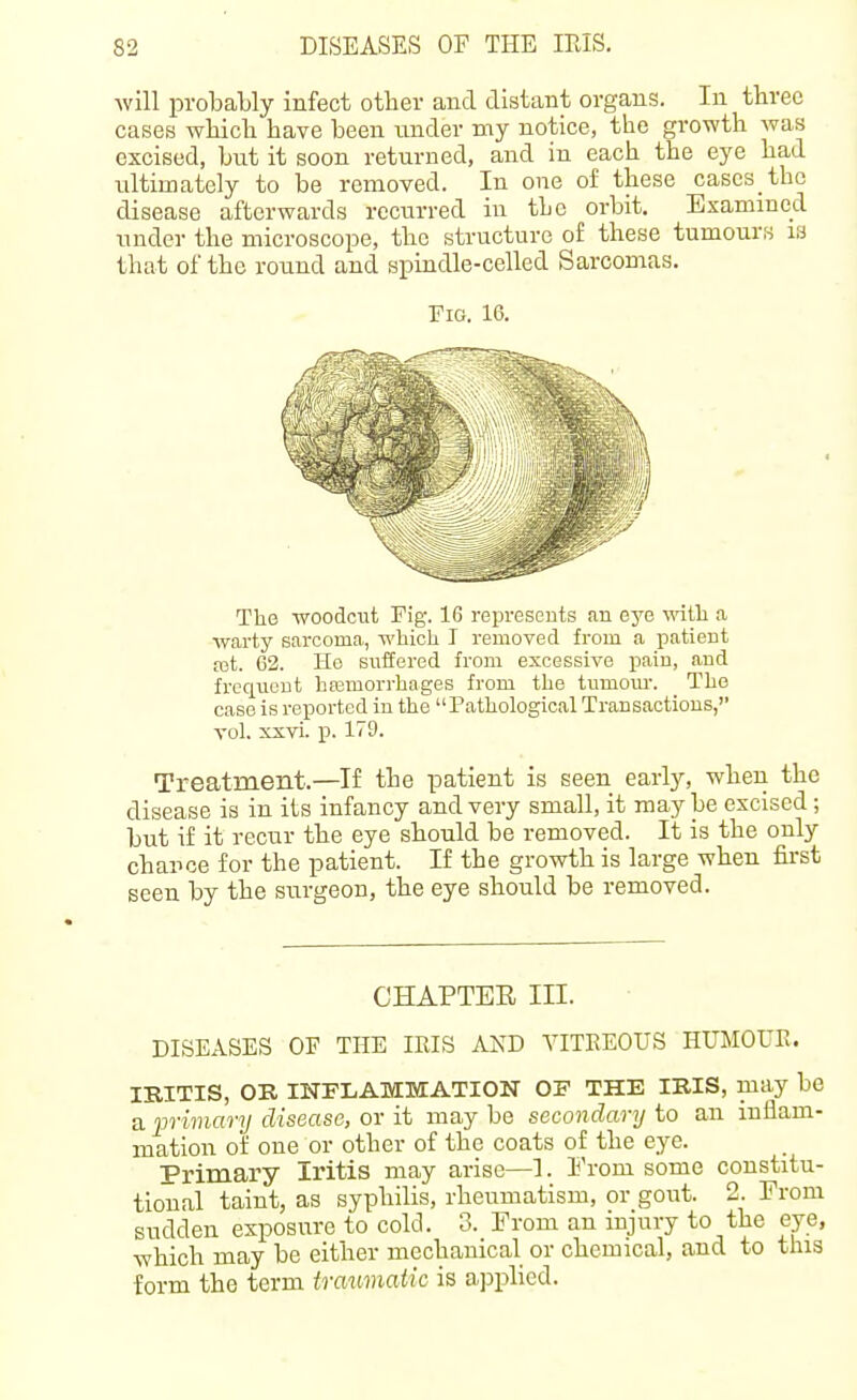 will probably infect other and distant organs. In three cases which have been under my notice, the growth was excised, but it soon returned, and in each the eye had ultimately to be removed. In one of these cascs thc disease afterwards recurred in the orbit. Esammcd under the microscope, the structure of these tumours is that of the round and spindle-celled Sarcomas. The woodciit Fig. 16 represents an eye vnih a warty sarcoma, wliicli I removed from a patient fet. C2. Ho suffered from excessive pain, and frequent hasmorrhages from tlie tumom-. Tlie case is reported in the Pathological Transactions, vol. xxvi. p. 179. Treatment.—If the patient is seen early, when the disease is in its infancy and very small, it maybe excised; but if it recur the eye should be removed. It is the only chance for the patient. If the growth is large when first seen by the surgeon, the eye should be removed. DISEASES OF THE IKIS AND YITKEOUS HUMOUR. IRITIS, OR INFLAMMATION OF THE IRIS, may be a immary disease, or it may be secondary to an inflam- mation of one or other of the coats of the eye. Primary Iritis may arise—I. From some constitu- tional taint, as syphilis, rheumatism, or gout. 2. From sudden exposure to cold. 3. From an injury to the eye, which may be either mechanical or chemical, and to this form the term traumatic is applied. Fig. 16. CHAPTER III.