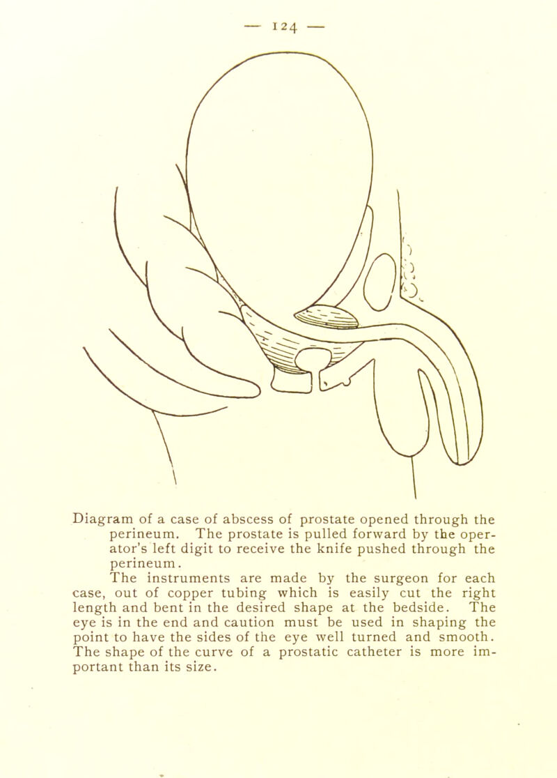 Diagram of a case of abscess of prostate opened through the perineum. The prostate is pulled forward by the oper- ator's left digit to receive the knife pushed through the perineum. The instruments are made by the surgeon for each case, out of copper tubing which is easily cut the right length and bent in the desired shape at the bedside. The eye is in the end and caution must be used in shaping the point to have the sides of the eye well turned and smooth. The shape of the curve of a prostatic catheter is more im- portant than its size.