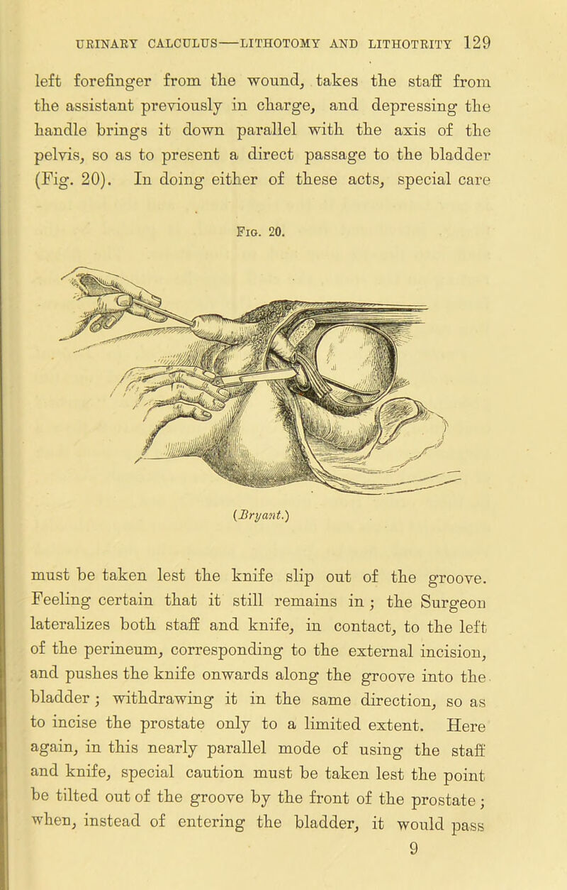 left forefinger from tlie wound, takes the staff from the assistant previously in charge, and depressing the handle brings it down parallel with the axis of the pelvis, so as to present a direct passage to the bladder (Fig. 20). In doing either of these acts, special care Fig. 20. {Bryant.) must be taken lest the knife slip out of the groove. Feeling certain that it still remains in ; the Surgeon lateralizes both staff and knife, in contact, to the left of the perineum, corresponding to the external incision, and pushes the knife onwards along the groove into the bladder; withdrawing it in the same direction, so as to incise the prostate only to a limited extent. Here again, in this nearly parallel mode of using the staff and knife, special caution must be taken lest the point be tilted out of the groove by the front of the prostate; when, instead of entering the bladder, it would pass 9