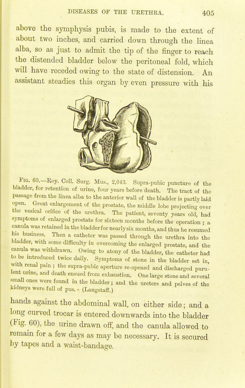 above the symphysis pubis, is made to the extent of about two inches, and carried down through the Unea alba, so as just to admit the tip of the finger to reach the distended bladder below the peritoneal fold, which will have receded owing to the state of distension. An assistant steadies this organ by even pressure with his Fig. 60.-Roy. CoU. Surg. Mus., 2,043. Supra-pubic puncture of the bladder, for retention of urine, four years before death. The tract of the passage from the linea alba to the anterior wall of the bladder is partly laid open. Great enlargement of the prostate, the middle lobe projecting over the vesical orifice of the urethra. The patient, seventy years old, had symptoms of enlarged prostate for sixteen months before the operation • a canula was retained in the bladderfor nearlysLx months, and thus he resumed his busmess. Then a catheter was passed through the urethra into the bladder, with some difficulty in overcoming the enlarged prostate, and the canula was withdrawn. Owing to atony of the bladder, the catheter had to be introduced twice daUy. Sj-mptoms of stone in the bladder set in. with renal pain ; the supra-pubic aperture re-opened and discharged puru- lent unne, and death ensued from exhaustion. One large stone and several small ones were found in the bladder; and the ureters and pelves of the kidneys were fuU of pus. • (Langstaff.) hands against the abdominal waU, on either side; and a long curved trocar is entered downwards into the bladder (Fig. 60), the urine drawn off, and the canula aUowed to remam for a few days as may be necessary. It is secured by tapes and a waist-bandage.