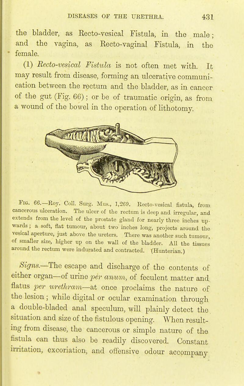 the bladder, as Recto-vesical Fistula, in the male; and the vagina, as Recto-vaginal Fistula, in the  female. (1) Recto-vesical Fistula is not often met with. It may result from disease, forming an ulcerative communi- cation between the rectum and the bladder, as in cancer of the gut (Fig. 66); or be of traumatic origin, as from a wound of the bowel m the operation of Hthotomy. Fig. 66.—Roy. Coll. Surg. Mus., 1,269. Eecto-vesical fistula, from cancerous ulceration. The ulcer of the rectum is deep and irregular, and extends from the level of the prostate gland for nearly three inches up- wards ; a soft, flat tumour, about two' inches long, projects around the vesical aperture, just above the ureters. There was another such tumour, of smaDer size, higher up on the wall of the bladder. All the tissue! around the rectum were indurated and contracted. (Hunterian.) Signs.—The escape and discharge of the contents of either organ—of urine ^^e?- anum, of feculent matter and flatus 2yer urethram—B.t once proclaims the nature of the lesion; while digital or ocular examination through a double-bladed anal speculum, will plainly detect the situation and size of the fistulous opening. When result- ing from disease, the cancerous or simple nature of the fistula can thus also be readily discovered. Constant irritation, excoriation, and offensive odour accompany