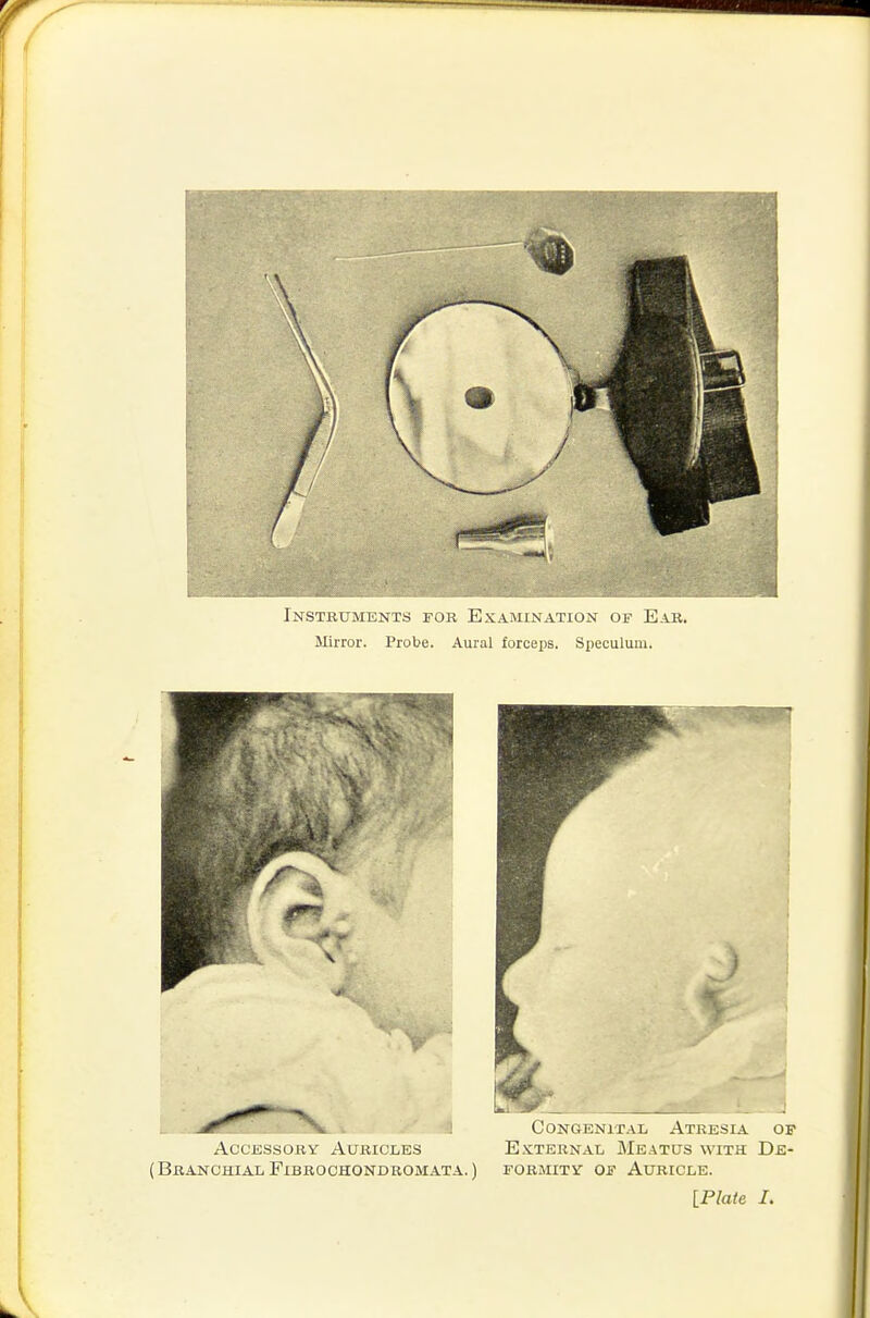 Instruments for Examination of Ear. Mirror. Probe. Aural forceps. Speculum. AccKSsoRY Auricles E.\;ternal Meatus with De- ( Branchial FiBROOHONDROMATA.) formity of Auricle. [Plate I.