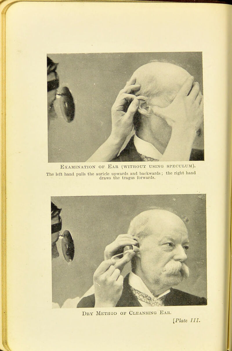 Examination of Ear (without using speculum). The left hand pulls the auricle upwards and backwards; the right hand draws the tragus forwards. Dry Method of CiiEANSiNG Ear. [Plate III.