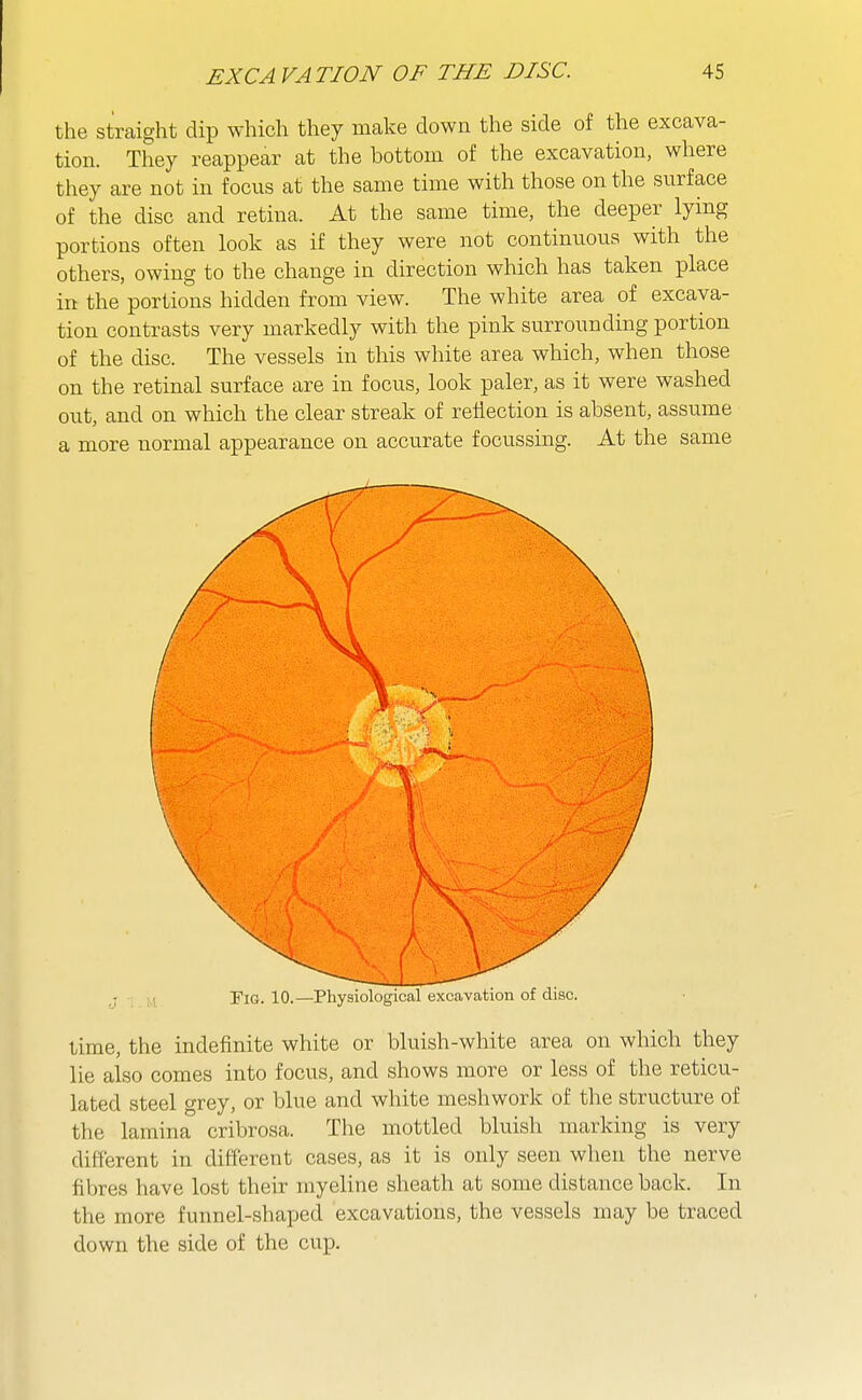 the straight dip which they make down the side of the excava- tion. They reappear at the bottom of the excavation, where they are not in focus at the same time with those on the surface of the disc and retina. At the same time, the deeper lying portions often look as if they were not continuous with the others, owing to the change in direction which has taken place in the portions hidden from view. The white area of excava- tion contrasts very markedly with the pink surrounding portion of the disc. The vessels in this white area which, when those on the retinal surface are in focus, look paler, as it were washed out, and on which the clear streak of reflection is absent, assume a more normal appearance on accurate focussing. At the same Fig. 10.—Physiological excavation of disc. time, the indefinite white or bluish-white area on which they lie also comes into focus, and shows more or less of the reticu- lated steel grey, or blue and white meshwork of the structure of the lamina cribrosa. The mottled bluish marking is very different in different cases, as it is only seen when the nerve fibres have lost their myeline sheath at some distance back. In the more funnel-shaped excavations, the vessels may be traced down the side of the cup.