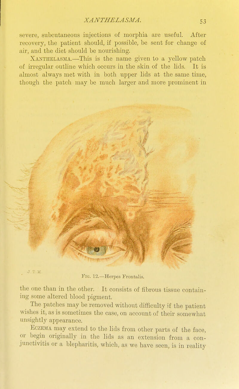 XANTHELASMA. severe, subcutaneous injections of morphia are useful. After recovery, the patient should, if possible, be sent for change of air, aiid the diet should be nourishing. Xanthelasma.—This is the name given to a yellow patch of irregular outline which occurs in the skin of the lids. It is almost always met with in both upper lids at the same time, though the patch may be much larger and more prominent in Fig. 12.—Herpes Frontalis. the one than in the other. It consists of fibrous tissue contain- ing some altered blood pigment. The patches may be removed without difficulty if the patient wishes it, as is sometimes the case, on account of tlieir somewhat un.sightly appearance. Eczema may extend to the lids from other parts of the face, or begin originally in the lids as an extension from a con- junctivitis or a blepharitis, whicli, as we have seen, is in reality