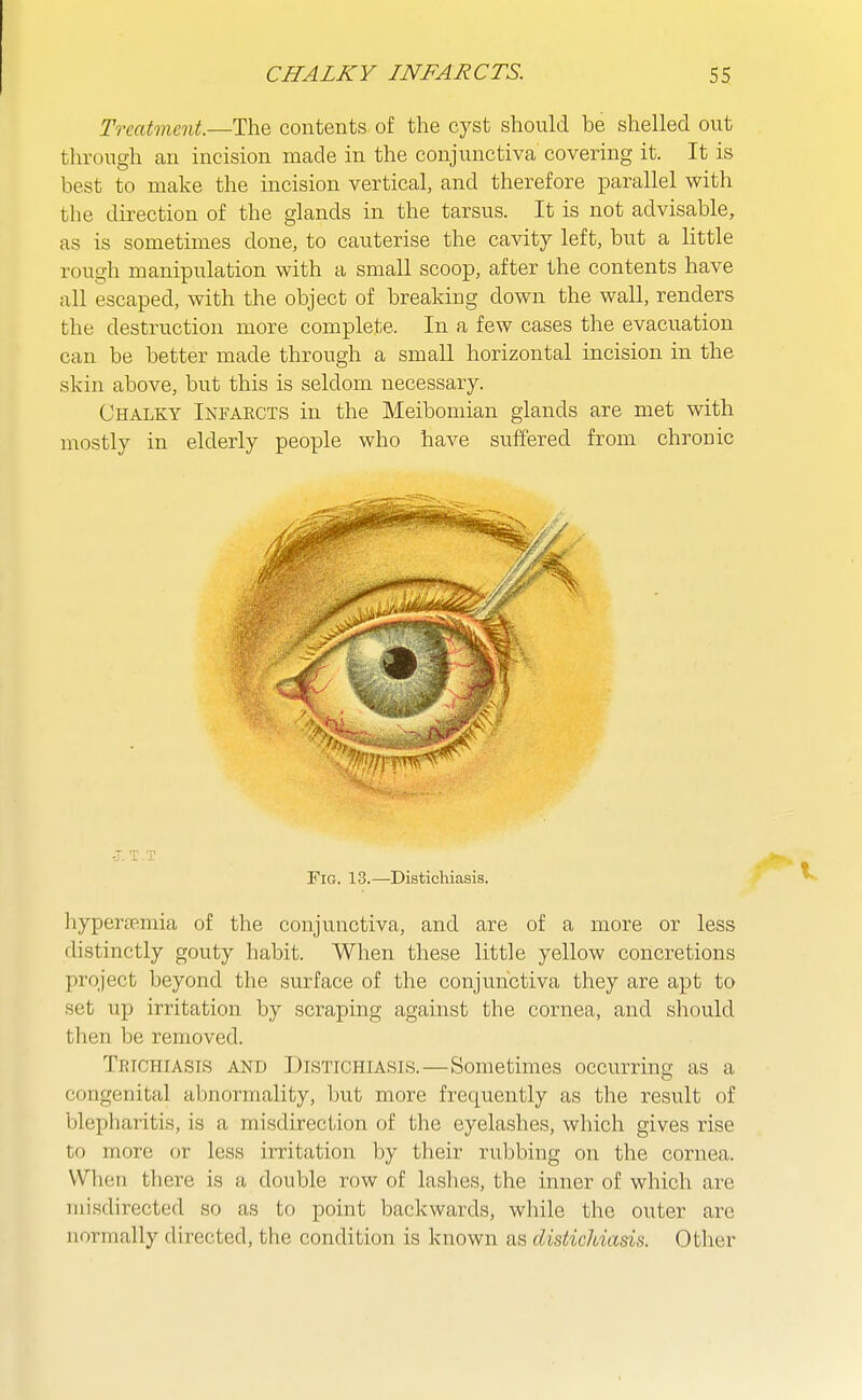 Treatment.—The contents of the cyst should be shelled out through an incision made in the conjunctiva covering it. It is best to make the incision vertical, and therefore parallel with the direction of the glands in the tarsus. It is not advisable, as is sometimes done, to cauterise the cavity left, but a little rough manipulation with a small scoop, after the contents have all escaped, with the object of breaking down the wall, renders the destruction more complete. In a few cases the evacuation can be better made through a small horizontal incision in the skin above, but this is seldom necessary. Chalky Infarcts in the Meibomian glands are met with mostly in elderly people who have suffered from chronic liyperpemia of the conjunctiva, and are of a more or less distinctly gouty habit. When these little yellow concretions project beyond the surface of the conjunctiva they are apt to set up irritation by scraping against the cornea, and should then be removed. Trtchiasis and Distichiasis.—Sometimes occurrino; as a congenital abnormality, but more frequently as the result of blepharitis, is a misdirection of the eyelashes, which gives rise to more or less irritation by their rubbing on the cornea. When there is a double row of laslies, the inner of which are misdirected so as to point backwards, while the outer are normally directed, the condition is known as distichiasis. Other -J. T T Fig. 13.—Distichiasis.
