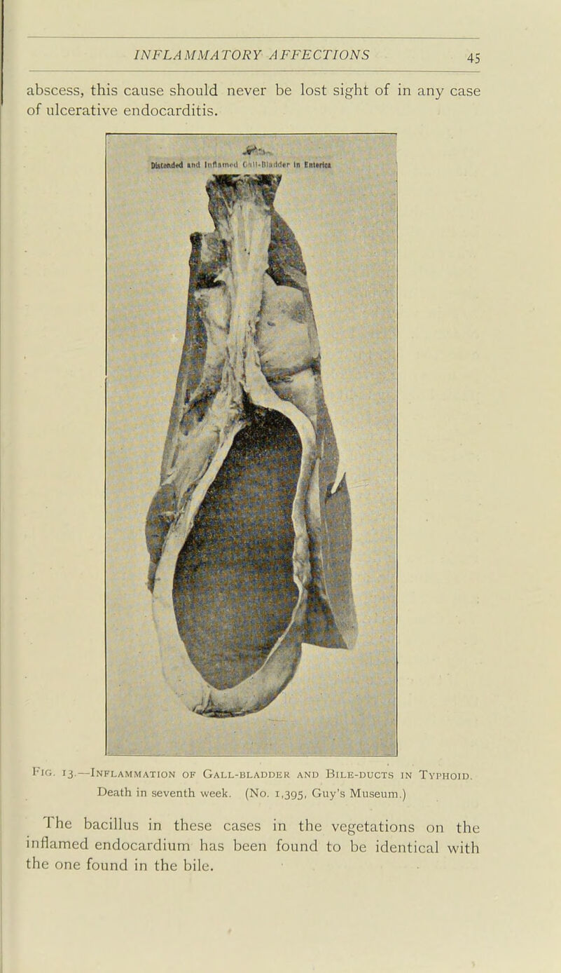 abscess, this cause should never be lost sight of in any case of ulcerative endocarditis. Dl<«xui«l ixd Inftimnl Cill-niniMer In EnMrtei ViG. 13.—Inflammation of Gall-bladder and Bile-ducts in Typhoid. Death in seventh week. (No. 1,395, Guy's Museum.) The bacillus in these cases in the vegetations on the inflamed endocardium has been found to be identical with the one found in the bile.