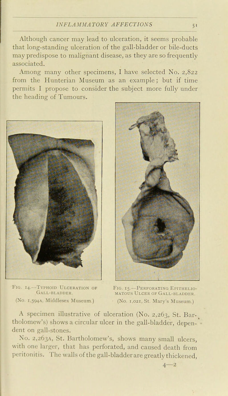 5' Although cancer may lead to ulceration, it seems probable that long-standing ulceration of the gall-bladder or bile-ducts may predispose to malignant disease, as they are so frequently associated. Among many other specimens, I have selected No. 2,822 from the Hunterian Museum as an example; but if time permits I propose to consider the subject more fully under the heading of Tumours. Fig. 14.--Typhoid Ulceration of Fig, 15.—Perforating Epithelio- Gall-bladder. matous Ulcer of Gall-bladder. (No. i,5g4A, Middlesex Museum.) (No. 1,021, St. Mary's Museum.) A specimen illustrative of ulceration (No. 2,263, St. Bar- tholomew's) shows a circular ulcer in the gall-bladder, depen- dent on gall-stones. No. 2,263A, St. Bartholomew's, shows many small ulcers, with one larger, that has perforated, and caused death from peritonitis. The walls of the gall-bladder are greatly thickened, 4—2