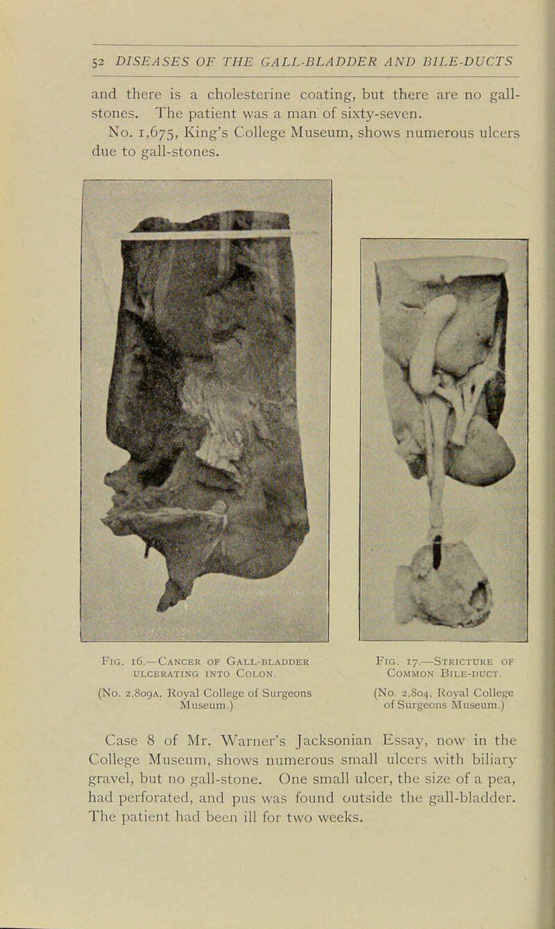 and there is a cholesterine coating, but there are no gall- stones. The patient was a man of sixty-seven. No. 1,675, King's College Museum, shows numerous ulcers due to gall-stones. Fig. i5.—Cancer of Gall-bladder Fig, 17.—Stricture of ulcerating into colon. common bile-duct. (No. 2,8o9A. Royal College of Surgeons (No. 2,804, Royal College Museum.) of Surgeons Museum.) Case 8 of Mr. Warner's Jacksonian Essa}', now in the College Museum, shows numerous small ulcei's with biliary gravel, but no gall-stone. One small ulcer, the size of a pea, had perforated, and pus was found outside the gall-bladder. The patient had been ill for two weeks.