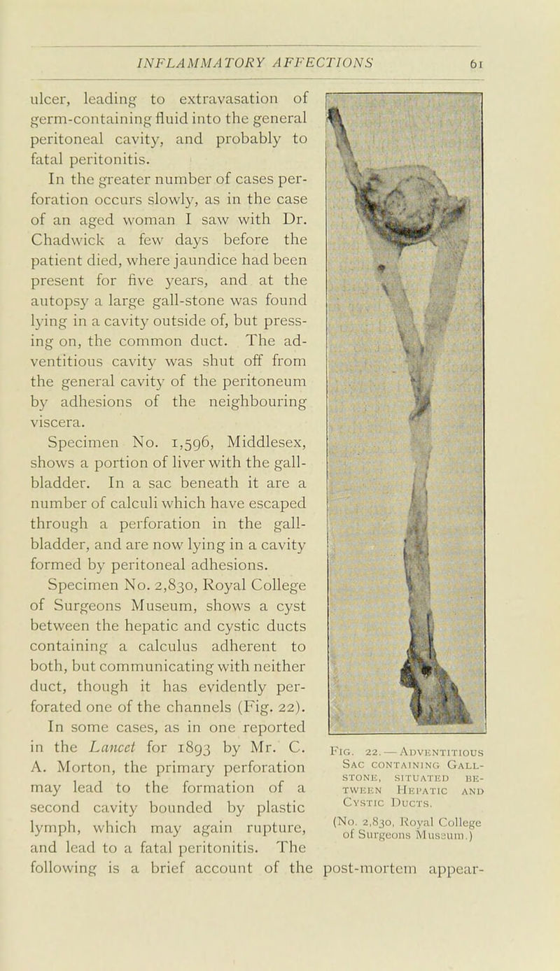 ulcer, leading to extravasation of germ-containing fluid into the general peritoneal cavity, and probably to fatal peritonitis. In the greater number of cases per- foration occurs slowly, as in the case of an aged woman I saw with Dr. Chadwick a few days before the patient died, where jaundice had been present for five years, and at the autopsy a large gall-stone was found lying in a cavity outside of, but press- ing on, the common duct. The ad- ventitious cavity was shut off from the general cavity of the peritoneum by adhesions of the neighbouring viscera. Specimen No. 1,596, Middlesex, shows a portion of liver with the gall- bladder. In a sac beneath it are a number of calculi which have escaped through a perforation in the gall- bladder, and are now lying in a cavity formed by peritoneal adhesions. Specimen No. 2,830, Royal College of Surgeons Museum, shows a cyst between the hepatic and cystic ducts containing a calculus adherent to both, but communicating with neither duct, though it has evidently per- forated one of the channels (Fig. 22). In some cases, as in one reported in the Lancet for 1893 by Mr. C, A. Morton, the primary perforation may lead to the formation of a second cavity bounded by plastic lymph, which may again rupture, and lead to a fatal peritonitis. The following is a brief account of the Fig. 22. — AnvjcNTiTious Sac containing Gall- stone, SITUATED BE- TWEEN Hepatic and Cystic Ducts. (No. 2,830, Royal College of Surgeons Mussum.) post-mortem appear-