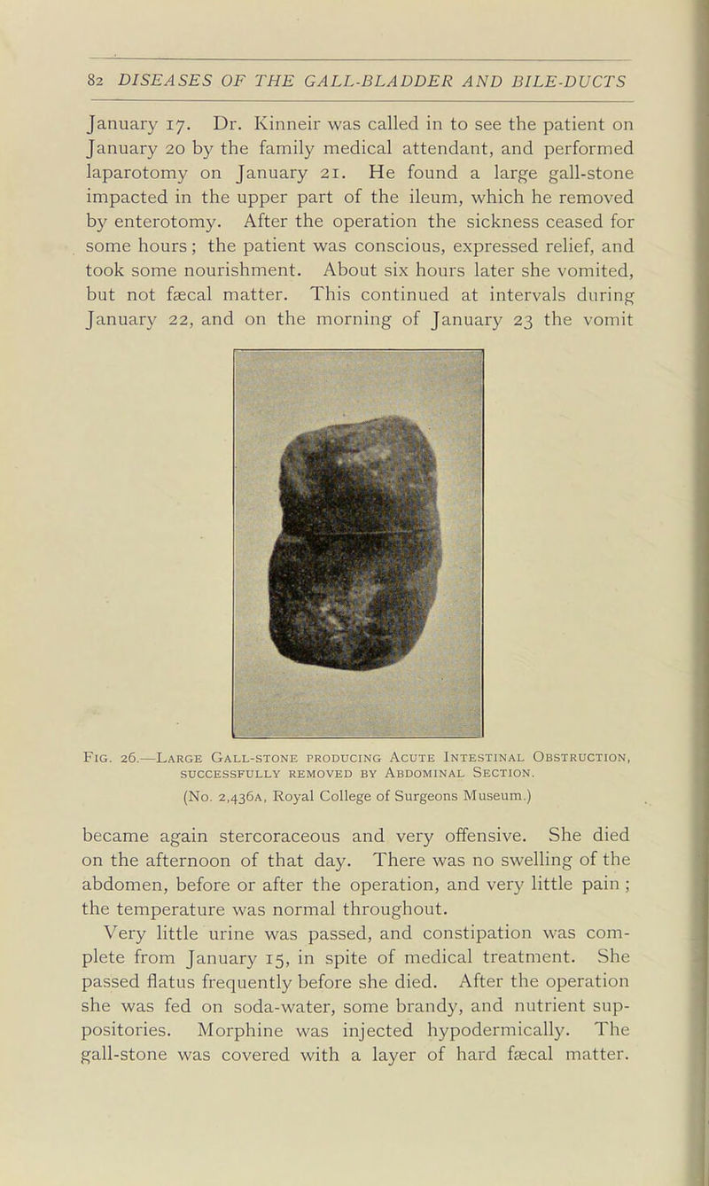 January 17, Dr. Kinneir was called in to see the patient on January 20 by the family medical attendant, and performed laparotomy on January 21. He found a large gall-stone impacted in the upper part of the ileum, which he removed by enterotomy. After the operation the sickness ceased for some hours; the patient was conscious, expressed relief, and took some nourishment. About six hours later she vomited, but not faecal matter. This continued at intervals during January 22, and on the morning of January 23 the vomit Fig. 26.—Large Gall-stone producing Acute Intestinal Obstruction, successfully removed by abdominal section. (No. 2,436a, Royal College of Surgeons Museum.) became again stercoraceous and very offensive. She died on the afternoon of that day. There was no swelling of the abdomen, before or after the operation, and very little pain ; the temperature was normal throughout. Very little urine was passed, and constipation was com- plete from January 15, in spite of medical treatment. She passed flatus frequently before she died. After the operation she was fed on soda-water, some brandy, and nutrient sup- positories. Morphine was injected hypodermically. The gall-stone was covered with a layer of hard fsecal matter.