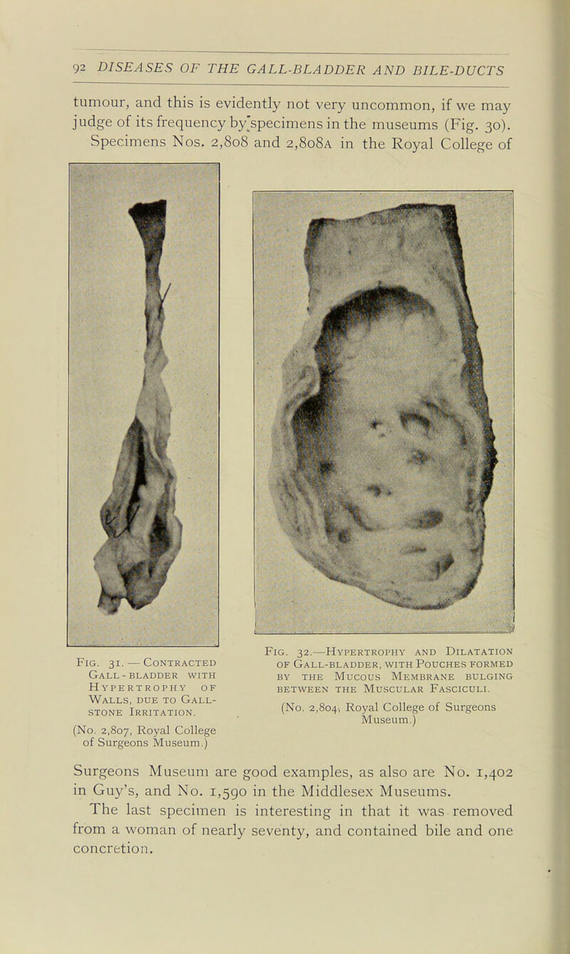 tumour, and this is evidently not very uncommon, if we may judge of its frequency by'specimens in the museums (Fig. 30). Specimens Nos. 2,808 and 2,8o8a in the Royal College of Fig. 31. — Contracted Gall-bladder with Hypertrophy of Walls, due to Gall- stone Irritation. (No. 2,807, Royal College of Surgeons Museum.) Fig. 32.—Hypertrophy and Dilatation OF Gall-bladder, with Pouches formed BY THE Mucous MEMBRANE BULGING BETWEEN THE MUSCULAR FASCICULI. (No. 2,8041 Royal College of Surgeons Museum.) Surgeons Museum are good examples, as also are No. 1,402 in Guy's, and No. 1,590 in the Middlesex Museums. The last specimen is interesting in that it was removed from a woman of nearly seventy, and contained bile and one concretion.