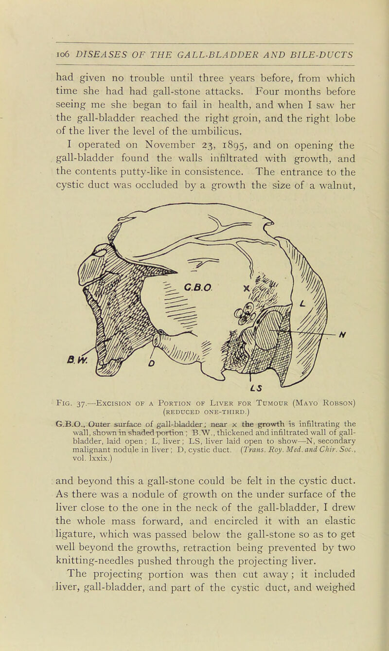 had given no trouble until three years before, from which time she had had gall-stone attacks. Four months before seeing me she began to fail in health, and when I saw her the gall-bladder reached the right groin, and the right lobe of the liver the level of the umbilicus. I operated on November 23, 1895, and on opening the gall-bladder found the walls infiltrated with growth, and the contents putty-like in consistence. The entrance to the cystic duct was occluded by a growth the size of a walnut, Fig. 37,—-Excision of a Portion of Liver for Tumour (Mayo Robson) (reduced one-third.) G.B.O., Outer surface of gall-bladder; near x the growth is infiltrating the wall, shown in shaded portion; B.W., thickened and infiltrated wall of gall- bladder, laid open ; L, liver; LS, liver laid open to show—N, secondary malignant nodule in liver; D, cystic duct. {Trans. Roy. Med. and Chir. Soc, vol. Ixxix.) and beyond this a gall-stone could be felt in the cystic duct. As there was a nodule of growth on the under surface of the liver close to the one in the neck of the gall-bladder, I drew the whole mass forward, and encircled it with an elastic ligature, which was passed below the gall-stone so as to get well beyond the growths, retraction being prevented by two knitting-needles pushed through the projecting liver. The projecting portion was then cut away ; it included liver, gall-bladder, and part of the cystic duct, and weighed