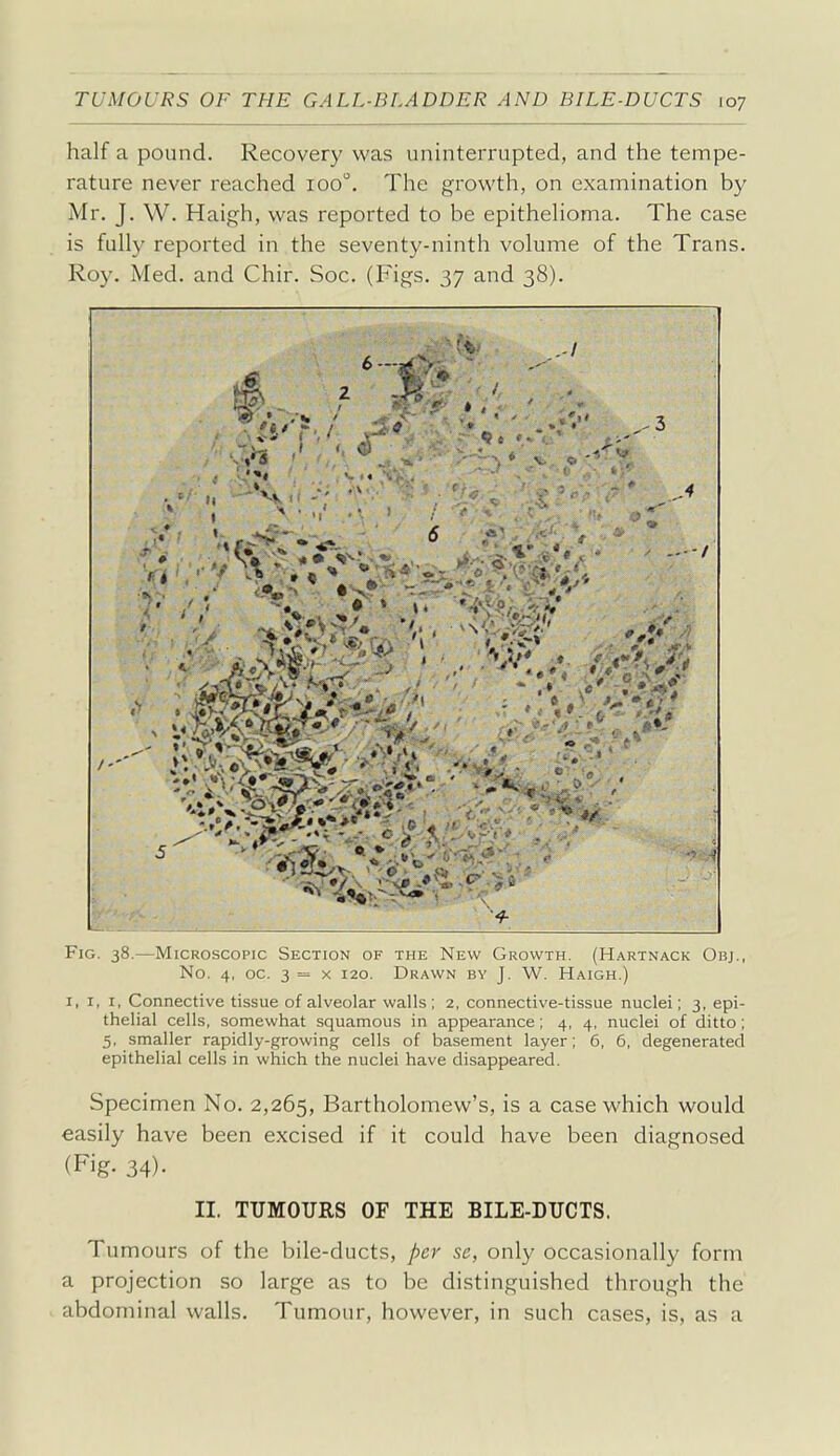 half a pound. Recovery was uninterrupted, and the tempe- rature never reached 100, The growth, on examination by Mr. J. W. Haigh, was reported to be epithehoma. The case is fully reported in the seventy-ninth volume of the Trans. Roy. Med. and Chir. Soc. (Figs. 37 and 38). 6- .-I si- ft * ^ \- ' ■ > ' •, '>, >• Fig. 38.—Microscopic Section of the New Growth. (Hartnack Obj., No. 4, oc. 3 = X 120. Drawn bv J. W. Haigh.) I, I, I, Connective tissue of alveolar walls; 2, connective-tissue nuclei; 3, epi- thelial cells, somewhat squamous in appearance; 4, 4, nuclei of ditto; 5, smaller rapidly-growing cells of basement layer; 6, 6, degenerated epithelial cells in which the nuclei have disappeared. Specimen No. 2,265, Bartholomew's, is a case which would easily have been excised if it could have been diagnosed (Fig- 34)- II. TTJMOTJRS OF THE BILE-DUCTS. Tumours of the bile-ducts, per se, only occasionally form a projection so large as to be distinguished through the abdominal walls. Tumour, however, in such cases, is, as a
