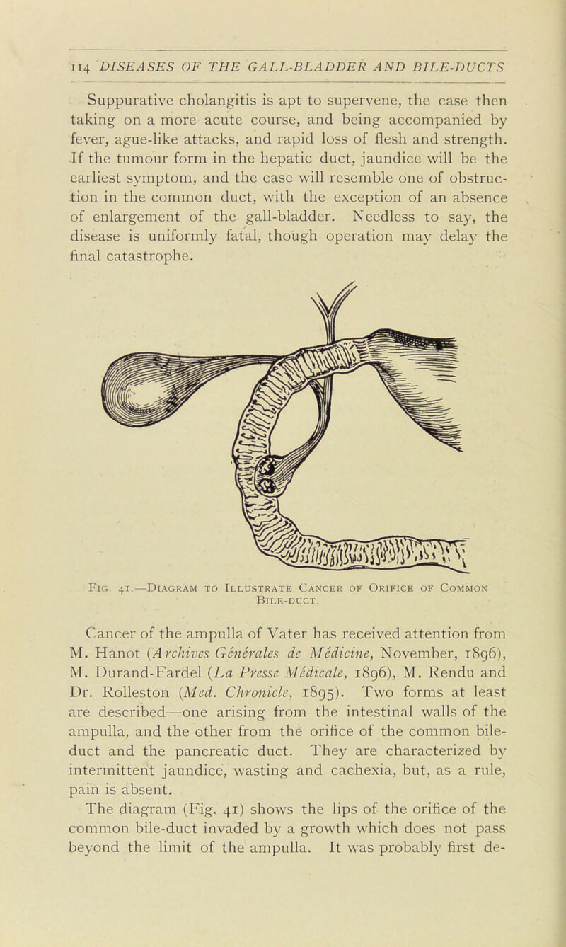 Suppurative cholangitis is apt to supervene, the case then taking on a more acute course, and being accompanied by fever, ague-Hke attacks, and rapid loss of flesh and strength. If the tumour form in the hepatic duct, jaundice will be the earliest symptom, and the case will resemble one of obstruc- tion in the common duct, with the exception of an absence of enlargement of the gall-bladder. Needless to say, the disease is uniformly fatal, though operation may delay the final catastrophe. Fig 41.—Diagram to Illustrate Cancer of Orifice of Common Bile-duct. Cancer of the ampulla of Vater has received attention from M. Hanot {Archives Generales de Medicine, November, i8g6), M. Durand-Fardel {La Presse Medicate, 1896), M. Rendu and Dr. Rolleston {Med. Chronicle, 1895). Two forms at least are described—one arising from the intestinal walls of the ampulla, and the other from the orifice of the common bile- duct and the pancreatic duct. They are characterized by intermittent jaundice, wasting and cachexia, but, as a rule, pain is absent. The diagram (Fig. 41) shows the lips of the orifice of the common bile-duct invaded by a growth which does not pass beyond the limit of the ampulla. It was probably first de-