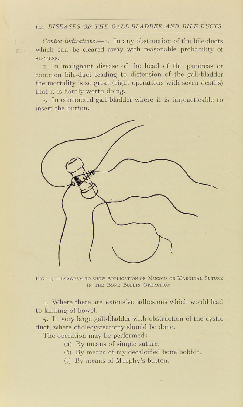 Contra-indications.—i. In any obstruction of the bile-ducts which can be cleared away with reasonable probability of success. 2. In malignant disease of the head of the pancreas or common bile-duct leading to distension of the gall-bladder the mortality is so great (eight operations with seven deaths) that it is hardly worth doing. 3. In contracted gall-bladder where it is impracticable to insert the button. Fig. 47.—Diagram to show Application of Mucous or Marginal Suture IN THE Bone Bobbin Operation. 4. Where there are extensive adhesions which would lead to kinking of bowel. 5. In very large gall-bladder with obstruction of the cystic duct, where cholecystectomy should be done. The operation may be performed : {a) By means of simple suture. (6) By means of my decalcified bone bobbin. (c) By means of Murphy's button.