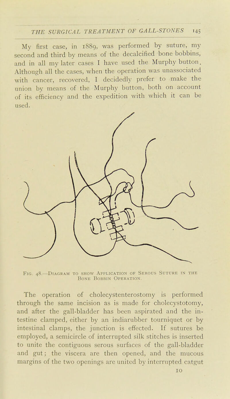 My first case, in i88g, was performed by suture, my second and third by means of the decalcified bone bobbins, and in all my later cases I have used the Murphy button. Althoufjh all the cases, when the operation was unassociated with cancer, recovered, I decidedly prefer to make the union by means of the Murphy button, both on account of its efficiency and the expedition with which it can be used. Fig. 48.—Diagram to show Application of Serous Suture in the Bone Bobbin Operation. The operation of cholecystenterostomy is performed through the same incision as is made for cholecystotomy, and after the gall-bladder has been aspirated and the in- testine clamped, either by an indiarubber tourniquet or by intestinal clamps, the junction is effected. If sutures be employed, a semicircle of interrupted silk stitches is inserted to unite the contiguous serous surfaces of the gall-bladder and gut; the viscera are then opened, and the mucous margins of the two openings are united by interrupted catgut 10
