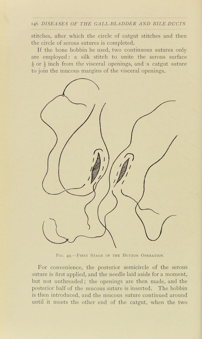 stitches, after which the circle of catgut stitches and then the circle of serous sutures is completed. If the bone bobbin be used, two continuous sutures only are employed: a silk stitch to unite the serous surface ^ or ^ inch from the visceral openings, and a catgut suture to join the mucous margins of the visceral openings. Fig. 49.—First Stage of the Button Operation. For convenience, the posterior semicircle of the serous suture is first applied, and the needle laid aside for a moment, but not unthreaded; the openings are then made, and the posterior half of the mucous suture is inserted. The bobbin is then introduced, and the mucous suture continued around until it meets the other end of the catgut, when the two