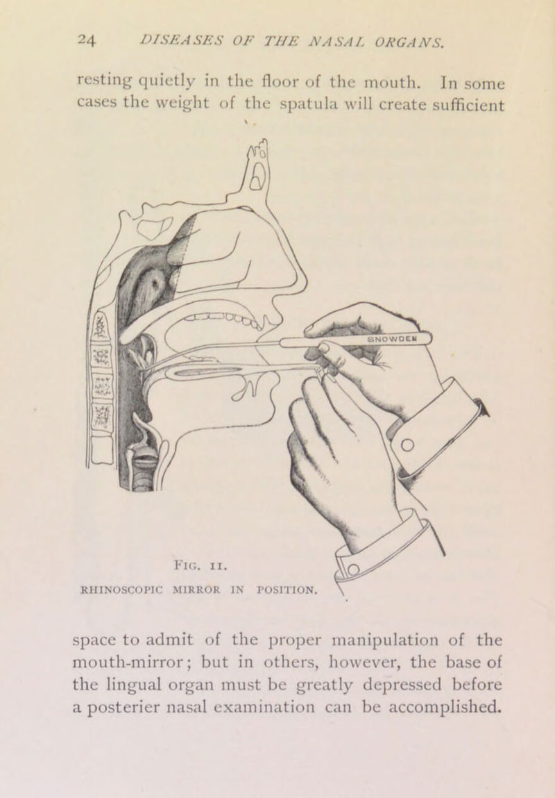 resting quietly in the floor of the mouth. In some cases the weight of the spatula will create sufficient Fig. ii. RHINOSCOPIC MIRROR IN POSITION. space to admit of the proper manipulation of the mouth-mirror; but in others, however, the base of the lingual organ must be greatly depressed before a posterior nasal examination can be accomplished.