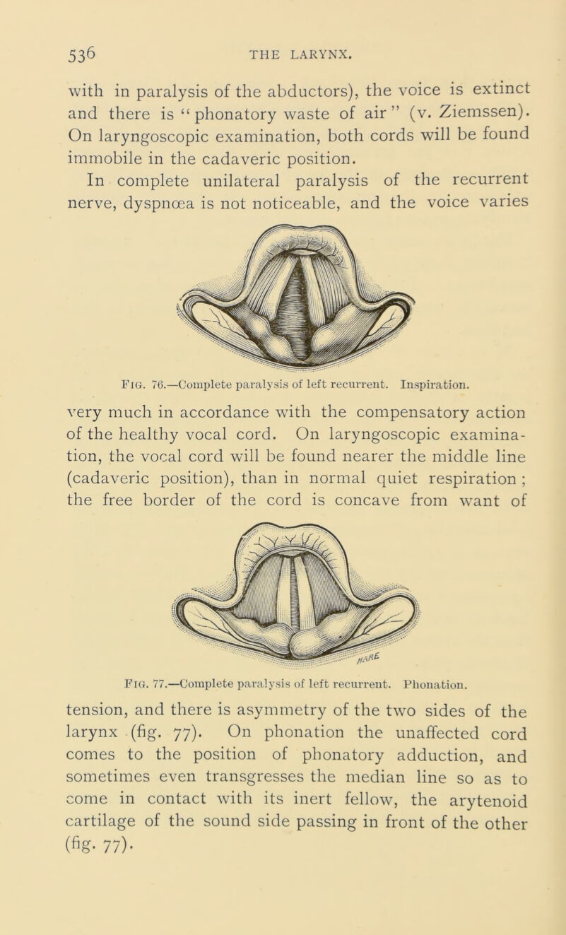 with in paralysis of the abductors), the voice is extinct and there is “ phonatory waste of air” (v. Ziemssen). On laryngoscopic examination, both cords will be found immobile in the cadaveric position. In complete unilateral paralysis of the recurrent nerve, dyspnoea is not noticeable, and the voice varies Fig. 76.—Complete paralysis of left recurrent. Inspiration. very much in accordance with the compensatory action of the healthy vocal cord. On laryngoscopic examina- tion, the vocal cord will be found nearer the middle line (cadaveric position), than in normal quiet respiration ; the free border of the cord is concave from wrant of Fig. 77.—Complete paralysis of left recurrent. Plionation. tension, and there is asymmetry of the two sides of the larynx (fig. 77). On plionation the unaffected cord comes to the position of phonatory adduction, and sometimes even transgresses the median line so as to come in contact with its inert fellow, the arytenoid cartilage of the sound side passing in front of the other 77)-