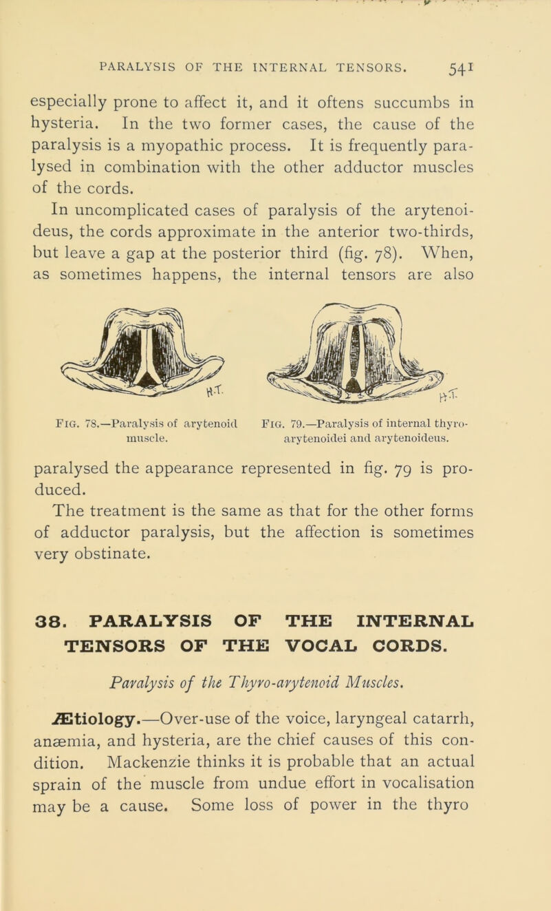 especially prone to affect it, and it oftens succumbs in hysteria. In the two former cases, the cause of the paralysis is a myopathic process. It is frequently para- lysed in combination with the other adductor muscles of the cords. In uncomplicated cases of paralysis of the arytenoi- deus, the cords approximate in the anterior two-thirds, but leave a gap at the posterior third (fig. 78). When, as sometimes happens, the internal tensors are also Fig. 78.—Paralysis of arytenoid Fig. 79.—Paralysis of internal thyro- paralysed the appearance represented in fig. 79 is pro- duced. The treatment is the same as that for the other forms of adductor paralysis, but the affection is sometimes very obstinate. 38. PARALYSIS OF THE INTERNAL TENSORS OF THE VOCAL CORDS. iEtiology.—Over-use of the voice, laryngeal catarrh, anaemia, and hysteria, are the chief causes of this con- dition. Mackenzie thinks it is probable that an actual sprain of the muscle from undue effort in vocalisation may be a cause. Some loss of power in the thyro muscle. arytenoidei and arytenoideus. Paralysis of the Thyro-arytenoid Muscles.
