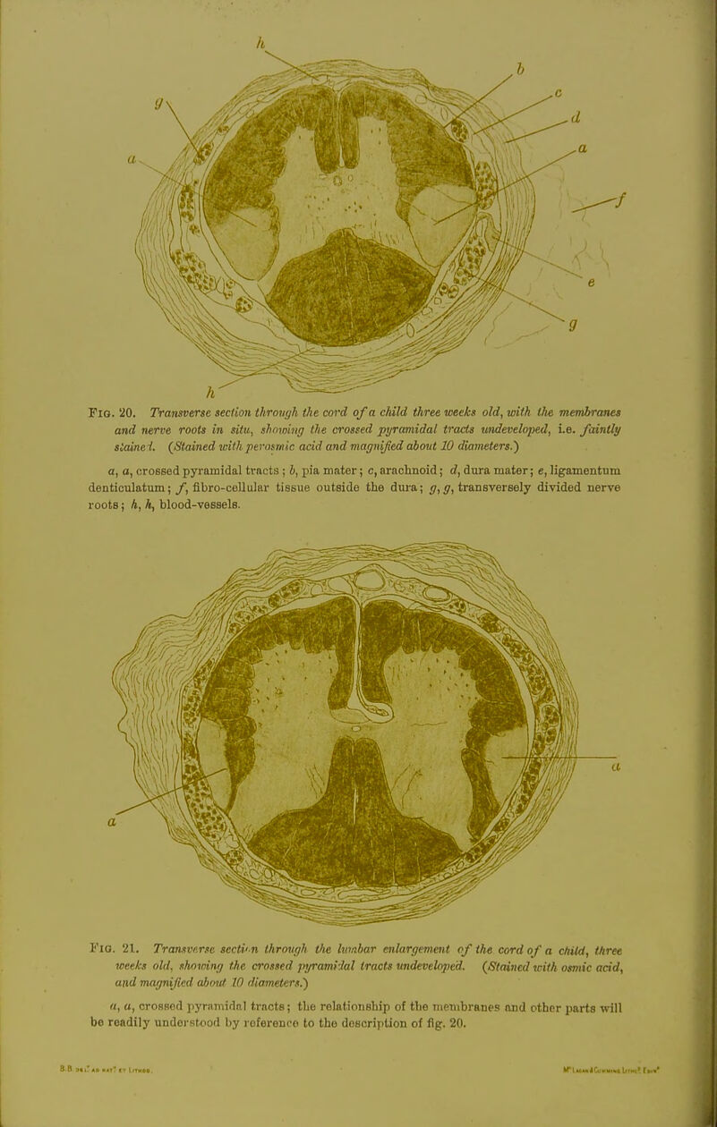 Fig. 20. Transverse section through the cord of a child three weeks old, with the membranes and nerve roots in situ, showing the crossed pyramidal tracts undeveloped, i.e. faintly siainei. (Stained with perosmic acid and magnified about 10 diameters.) a, a, crossed pyramidal tracts ; 6, pia mater; c, arachnoid; d, dura mater; e, ligamentum denticulatum; f, flbro-ceUular tissue outside the dura; g, g, transversely divided nerve roots; h, h, blood-vessels. Fio. 21. Transverse sccti'-n through the lumbar enlargement of the cord of a child, three weeks old, showing the crossed jnjrami:lal tracts undeveloped. (Stained with osmic acid, and magnified about 10 diameters.') a, a, crossed pyramidal tracts; the relationship of the membranes and other parts will be readily understood by roferenco to the description of fig. 20.