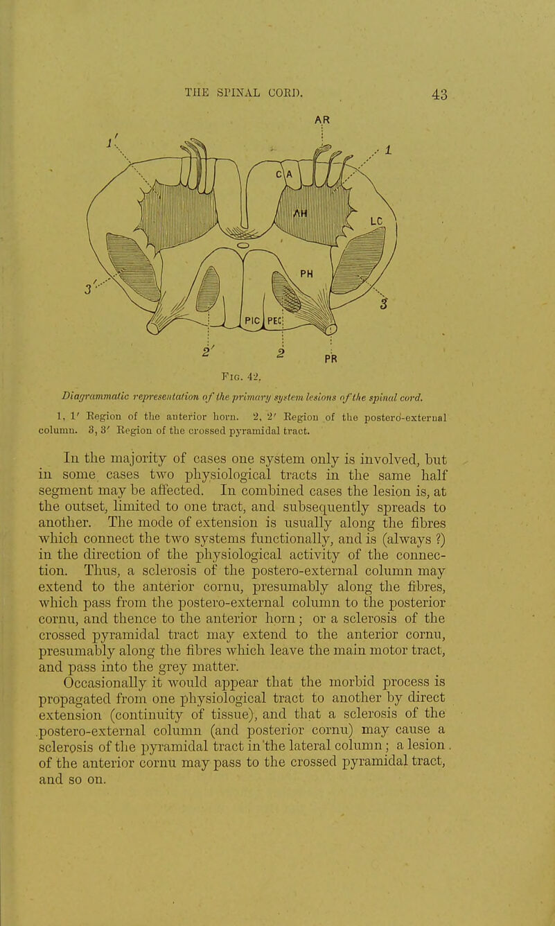 AR Fig. 42. Diagrammatic representation of the primary system lesions of the spinal cord. 1, 1' Region of the anterior horn. 2, 2' Region of the posterd-exterual column. 3, 3' Region of the crossed pyramidal tract. Iii the majority of cases one system only is involved, but in some cases two physiological tracts in the same half segment may be affected. In combined cases the lesion is, at the outset, limited to one tract, and subsequently spreads to another. The mode of extension is usually along the fibres which connect the two systems functionally, and is (always ?) in the direction of the physiological activity of the connec- tion. Thus, a sclerosis of the postero-external column may extend to the anterior cornu, presumably along the fibres, which pass from the postero-external column to the posterior cornu, and thence to the anterior horn; or a sclerosis of the crossed pyramidal tract may extend to the anterior cornu, presumably along the fibres which leave the main motor tract, and pass into the grey matter. Occasionally it would appear that the morbid process is propagated from one physiological tract to another by direct extension (continuity of tissue), and that a sclerosis of the .postero-external column (and posterior cornu) may cause a sclerosis of the pyramidal tract in'the lateral column; a lesion. of the anterior cornu may pass to the crossed pyramidal tract, and so on.