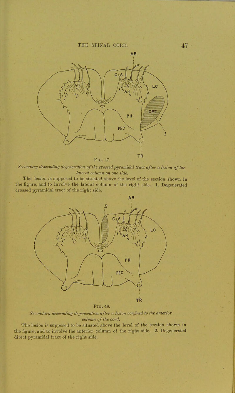 AR Secondary descending degeneration of the crossed pyramidal tract after a lesion of the lateral column on one side. The lesion is supposed to be situated above the level of the section shown in the figure, and to involve the lateral column of the right side. 1. Degenerated crossed pyramidal tract of the right side. AR TR Fig. 48. Secondary descending degeneration afar a lesion confined to the anterior column of the cord. The lesion is supposed to be situated above the level of the section shown in the figure, and to involve the anterior column of the right side. 2. Degenerated direct pyramidal tract of the right side.