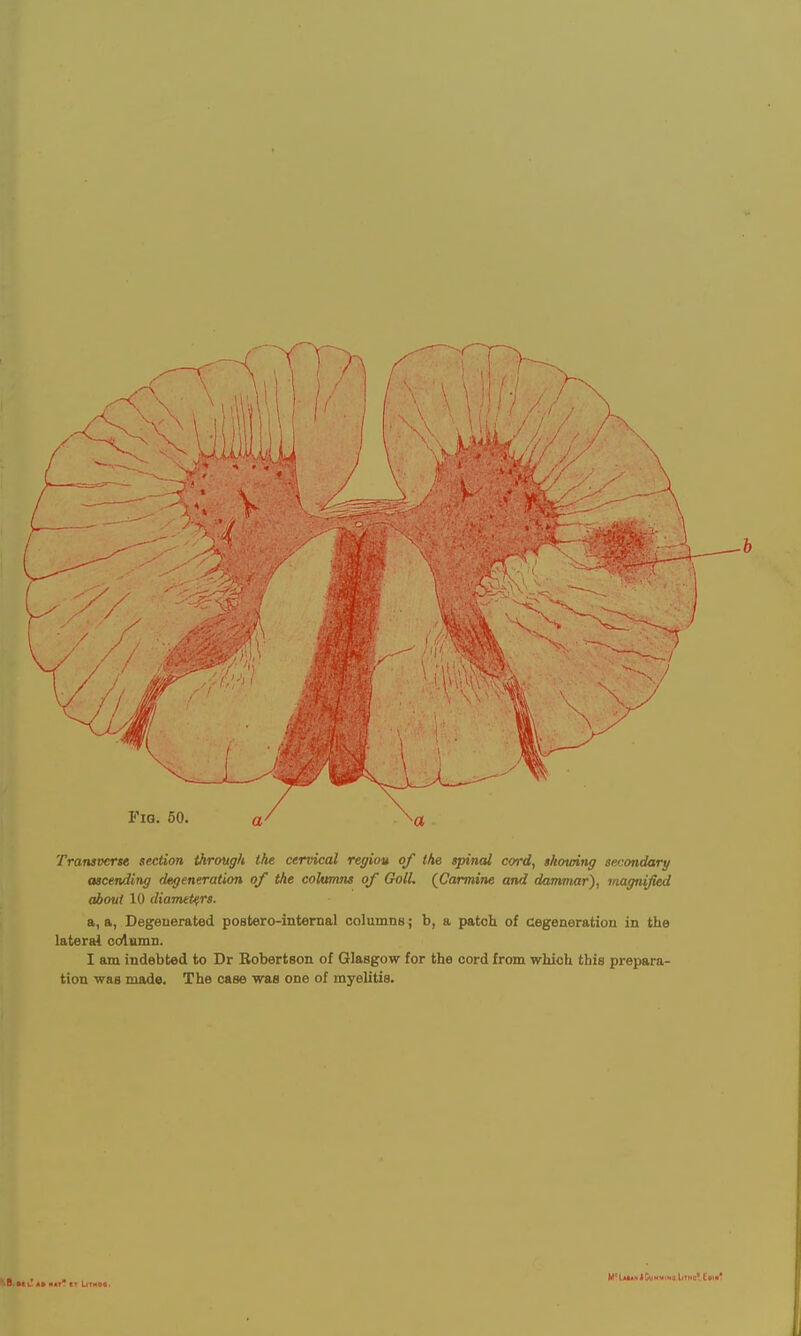 Transverse section through the cervical region of the spinal cord, showing secondary ascending degeneration of the columns of Goll. (Carmine and dammar'), magnified about 10 diameters. a, a, Degenerated poBtero-internal columnB; b, a patch of cegeneration in the lateral column. I am indebted to Dr Robertson of Glasgow for the cord from which this prepara- tion was made. The case was one of myelitis. Nor' At MT? It LlTH0«. V i... ■ 1 - • ■ Limo* Com'