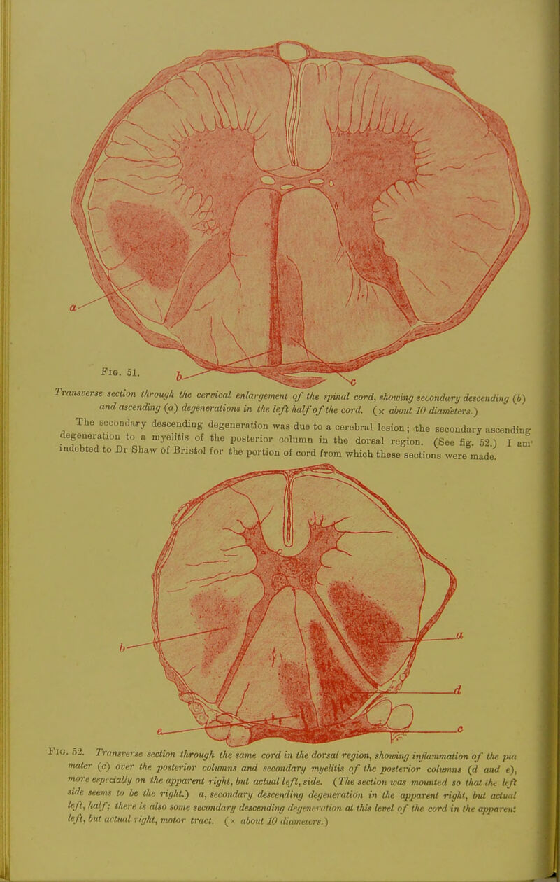 1 Fio. 51. Transverse section through the cervical enlargement of the fpinal cord, showing secondary descending (b) and ascending (a) degenerations in the left half of the cord, (x about 10 diameters.) The secondary descending degeneration was due to a cerebral lesion; the secondary ascending degeneration to a myelitis of the posterior column in the dorsal region. (See fig 52 1 I am' indebted to Dr Shaw 6f Bristol for the portion of cord from which these sections were made i io. 52. Transverse section through the same cord in the dorsal region, showing inflammation of the put mater (c) over the posterior columns and secondary myelitis of the posterior columns (d and e), more especially on the apparent right, but actual left, side. (The section was mounted so that the left side seams to be the right.) a, secondary descending degeneration in the apparent right, but actual left, lialj; there is also some secondary descending degeneration at this level of the cord in the apjyartn: left, but acttml right, motor tract. ( * about 10 diameters.)