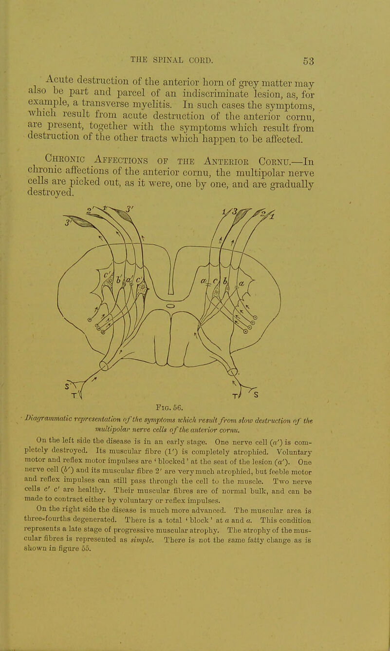 Acute destruction of the anterior horn of grey matter may also he part and parcel of an indiscriminate lesion, as, for example, a transverse myelitis. In such cases the symptoms, which result from acute destruction of the anterior cornu, care present, together with the symptoms which result from destruction of the other tracts which happen to he affected. Cheonic Affections of the Anteeioe Coenu.—In chronic affections of the anterior cornu, the multipolar nerve cells are picked out, as it were, one hy one, and are gradually destroyed. Pig. 56. Diagrammatic representation of the symptoms which result from slow destruction of the multipolar nerve cells of the anterior cornu. On the left side the disease is in an early stage. One nerve cell («') is com- pletely destroyed. Its muscular fibre (1') is completely atrophied. Voluntary motor and reflex motor impulses are ' blocked' at the seat of the lesion (a'). One nerve cell (&') and its muscular fibre 2' are very much atrophied, but feeble motor and reflex impulses can still pass through the cell to the muscle. Two nerve cells c' c' are healthy. Their muscular fibres are of normal bulk, and can be made to contract either by voluntary or reflex impulses. On the right side the disease is much more advanced. The muscular area is three-fourths degenerated. There is a total ' block ' at a and a. This condition represents a late stage of progressive muscular atrophy. The atrophy of the mus- cular fibres is represented as simple. There is not the eamo fatty change as is shown in figure 55.