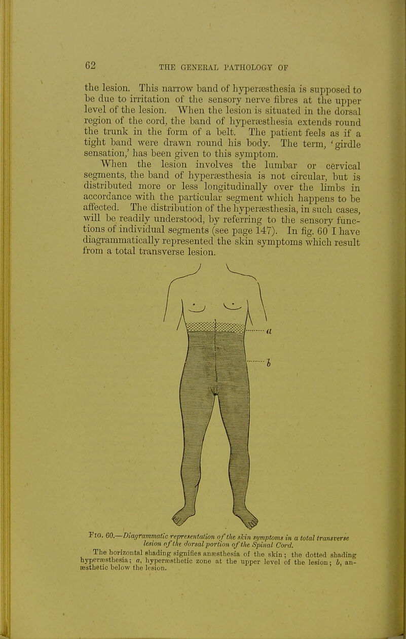 the lesion. This narrow band of hyperesthesia is supposed to he due to irritation of the sensory nerve fibres at the upper level of the lesion. When the lesion is situated in the dorsal region of the cord., the band of hyperesthesia extends round the trunk in the form of a belt. The patient feels as if a tight band were drawn round his body. The term, 'girdle sensation,' has been given to this symptom. When the lesion involves the lumbar or cervical segments, the band of hyperesthesia is not circular, but is distributed more or less longitudinally over the limbs in accordance with the particular segment which happens to be affected. The distribution of the hyperesthesia, in such cases, will be readily understood, by referring to the sensory func- tions of individual segments (see page 147). In fig. 60 I have (^grammatically represented the skin symptoms which result from a total transverse lesion. Fig. GO— Diagrammatic representation of the shin symptoms in a total transverse lesion of the dorsal portion of the Spinal Cord. The horizontal shading signifies anesthesia of the skin ; the dotted slinding hyperesthesia; a, hyperesthetic zone at the upper level of the lesion: b, an- esthetic below the lesion.