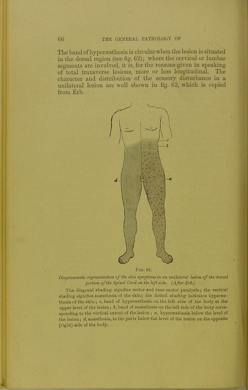The Land of hyperesthesia is circular when the lesion is situated in the dorsal region (see fig. 02); where the cervical or lumbar segments are involved, it is, for the reasons given in speaking of total transverse lesions, more or less longitudinal. The character and distribution of the sensory disturbance in a unilateral lesion are well shown in fig. 02, which is copied from Erb. Pig. 62. Diagrammatic representation of the shin symptonu in an unilateral lesion of the dorsal portion of the Spinal Cord on the left side. (After Erb.) The diagonal shading signifies motor and vaso-motor paralysis; the vertical shading signifies ansesthesia of the skin; the dotted shading indicates hyperes- thesia of the skin; c, band of hyperesthesia on the left side of the body at the upper level of the lesion; b, band of anaesthesia on the left side of the body corre- sponding to the vertical extent of the lesion ; a, hyperesthesia below the level of the lesion; d, auiesthesia, in the parts below the lovel of the lesion on the opposite (right) side of the body.