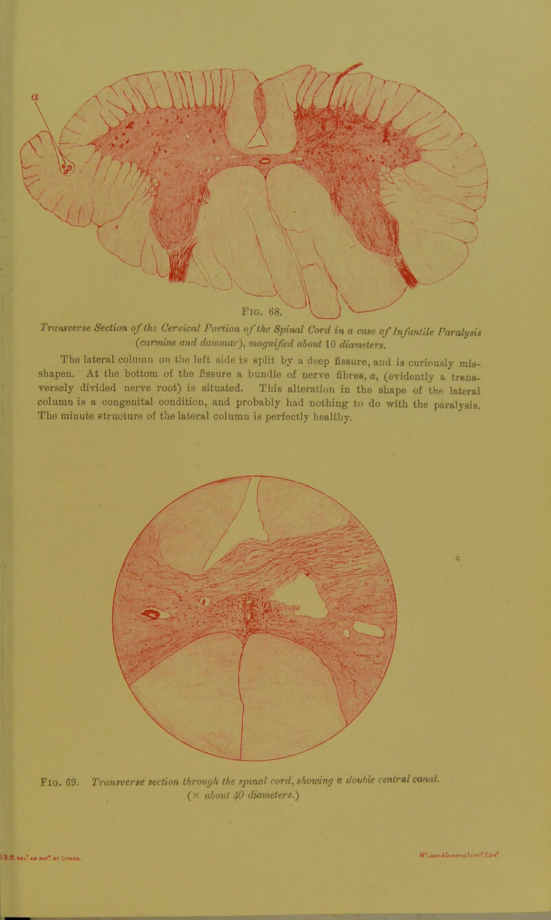 Transverse Section of the Cervical Portion of the Spinal Cord in a case of Infantile Paralysis {carmine and dammar'), magnified about 10 diameters. The lateral column on tlio left side is split by a deep fissure, and is curiously mis- shapen. At the bottom of the fissure a bundle of nerve fibres, a, (evidently a trans- versely divided nerve root) is situated. This alteration in the shape of the lateral column is a congenital condition, and probably had nothing to do with the paralysis. The miuute structure of the lateral column is perfectly healthy. S 3.B Oil' la H»T* KT IfTHOB