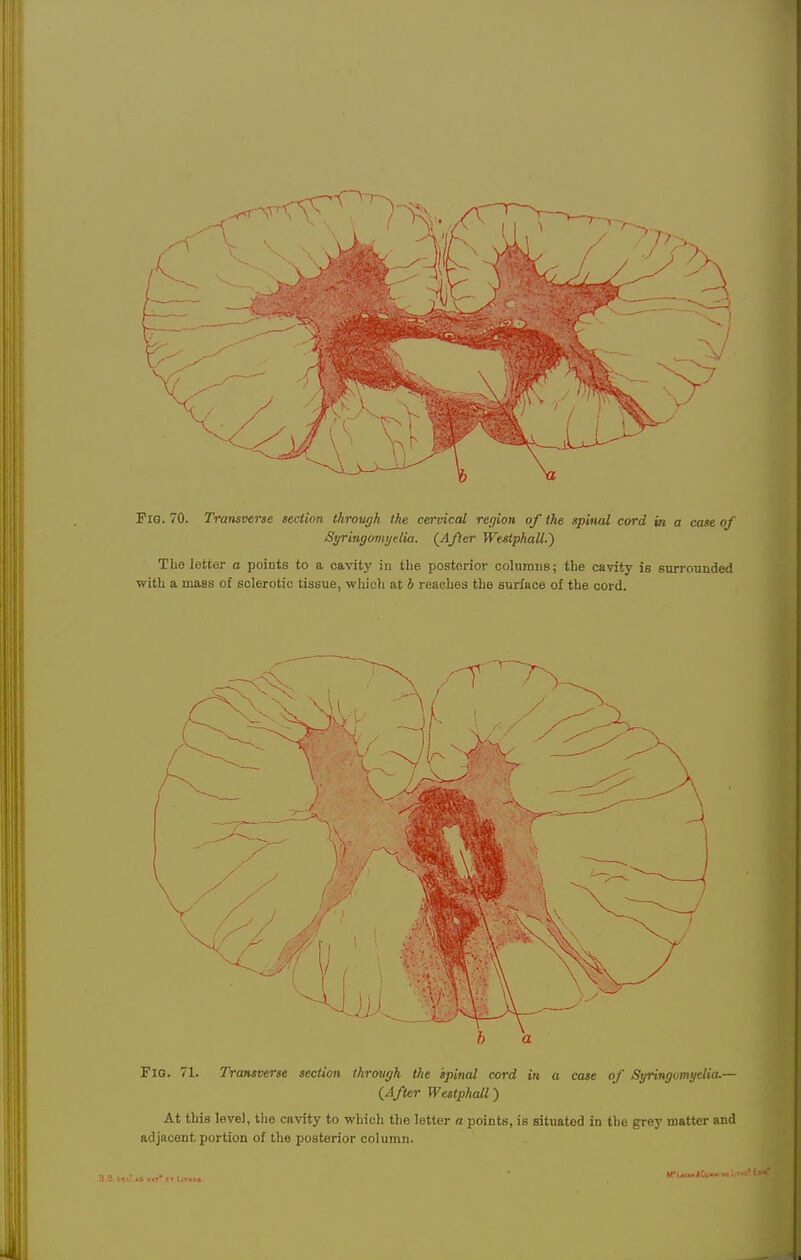 Pig. 70. Transverse section through the cervical region of the spinal cord in a case of Syringomyelia. {After Westphall.) The letter a points to a cavity in the posterior columns; the cavity is surrounded with a mass of sclerotic tissue, which at b reaches the surface of the cord. >l I-lV tit *»t If LlTMOfi