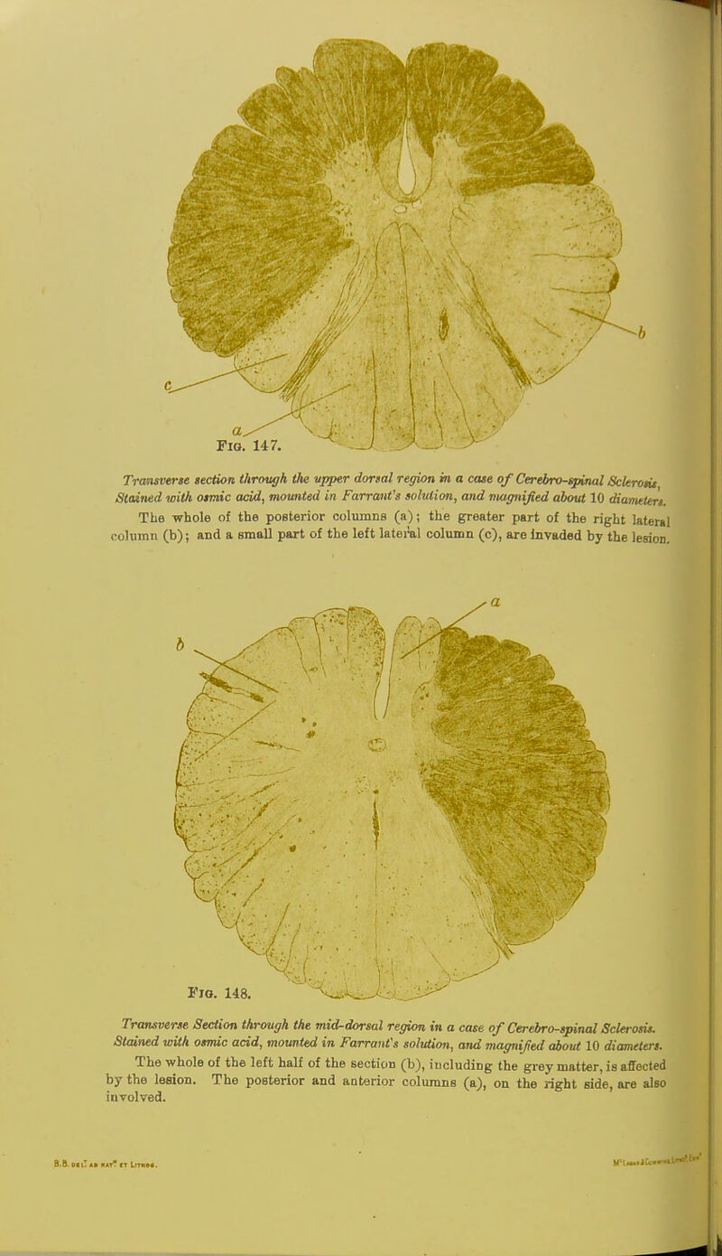 Stained ivitft osmic acid, mounted in Farrant's solution, and magnified about 10 diameters. The whole of the posterior columns (a); the greater part of the right lateral column (b); and a small part of the left lateral column (c), are invaded by the lesion. Transverse Section through the mid-dorsal region in a case of Cerebrospinal Sclerosis. Stained with osmic acid, mounted in Farrant's solution, and magnified about 10 diameters. The whole of the left half of the section (b), including the grey matter, is affected by the lesion. The posterior and anterior columns (a), on the right side, are also involved. B.B Oil At HAT? IT LlTKoa. HMm.^ICa—'^'1