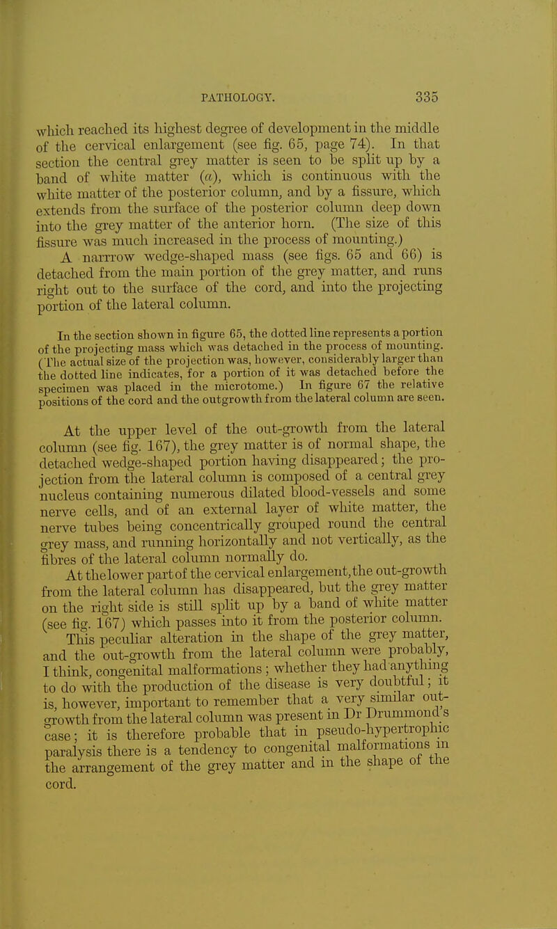 which reached its highest degree of development in the middle of the cervical enlargement (see fig. 65, page 74). In that section the central grey matter is seen to he split up hy a hand of white matter (a), which is continuous with the white matter of the posterior column, and by a fissure, which extends from the surface of the posterior column deep down into the grey matter of the anterior horn. (The size of this fissure was much increased in the process of mounting.) A narrrow wedge-shaped mass (see figs. 65 and 66) is detached from the main portion of the grey matter, and runs right out to the surface of the cord, and into the projecting portion of the lateral column. In the section shown in figure 65, the dotted line represents a portion of the projecting mass which was detached in the process of mounting. (The actual size of the projection was, however, considerably larger than the dotted line indicates, for a portion of it was detached before the specimen was placed in the microtome.) In figure 67 the relative positions of the cord and the outgrowth from the lateral column are seen. At the upper level of the out-growth from the lateral column (see fig. 167), the grey matter is of normal shape, the detached wedge-shaped portion having disappeared; the pro- jection from the lateral column is composed of a central grey nucleus containing numerous dilated blood-vessels and some nerve cells, and of an external layer of white matter, the nerve tubes being concentrically grouped round the central grey mass, and running horizontally and not vertically, as the fibres of the lateral column normally do. At thelower part of the cervical enlargement, the out-growth from the lateral column has disappeared, but the grey matter on the right side is still split up by a band of white matter (see fig. 167) which passes into it from the posterior column. This peculiar alteration in the shape of the grey matter, and the out-growth from the lateral column were probably, I think, congenital malformations ; whether they had ■anything to do with the production of the disease is very doubtful; it is however, important to remember that a very similar out- growth from the lateral column was present m Dr DrummoncL s case; it is therefore probable that in pseudohypertrophic paralysis there is a tendency to congenital malformations in the arrangement of the grey matter and in the shape of the cord.