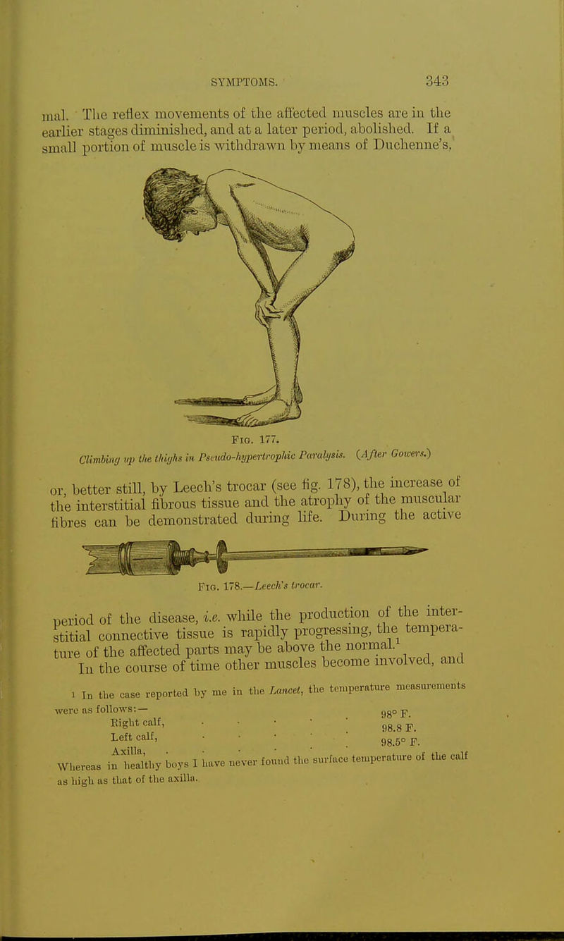 mal The reflex movements of the affected muscles are in the earlier stages diminished, and at a later period, abolished. If a .small portion of muscle is withdrawn by means of Duchenne's, Pig. 177. Climbing up Hie thighs in Psi vdo-hypertropUc Paralysis. {After Cowers.) or better still, by Leech's trocar (see fig. 178), the increase of the interstitial fibrous tissue and the atrophy of the muscular fibres can be demonstrated during life. During the active Fig. ITS.—Leech's trocar. neriod of the disease, i.e. while the production of the inter- stitial connective tissue is rapidly progressing, the tempera- ture of the affected parts may be above the normal. In the course of time other muscles become involved, and » In the case reported by me in the Lancet, the temperature measurements were as follows:— 98° F. Eight calf, • • • 98.8 F. Left calf, • • • gg go p Whereas intaUhy boys 1 have never found the'surface temperature of the calf as high as that of the axilla.