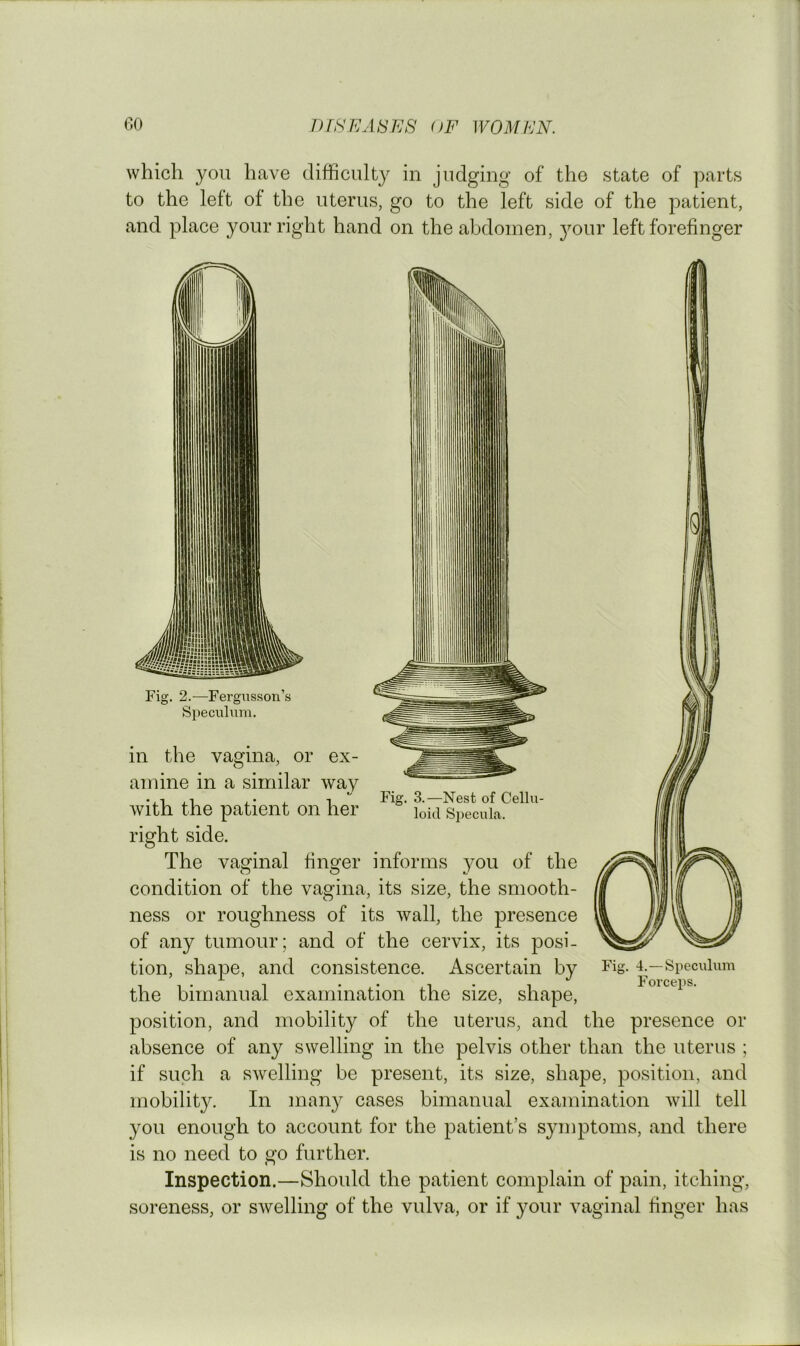 which you have difficulty in judging of the state of parts to the left of the uterus, go to the left side of the patient, and place your right hand on the abdomen, }mur left forefinger Fig. 2.—Fergusson’s Specvilum. Fig. 3.—Nest of Cellu- loid Specula. in the vagina, or ex- amine in a similar way with the patient on her right side. The vaginal finger informs you of the condition of the vagina, its size, the smooth- ness or roughness of its wall, the presence of any tumour; and of the cervix, its posi- tion, shape, and consistence. Ascertain by the bimanual examination the size, shape, position, and mobility of the uterus, and the presence or absence of any swelling in the pelvis other than the uterus ; if such a swelling be present, its size, shape, position, and mobility. In many cases bimanual examination Avill tell you enough to account for the patient’s symptoms, and there is no need to go further. Inspection.—Should the patient complain of pain, itching, soreness, or swelling of the vulva, or if your vaginal finger has Fig. 4.—Speculum Forceps.