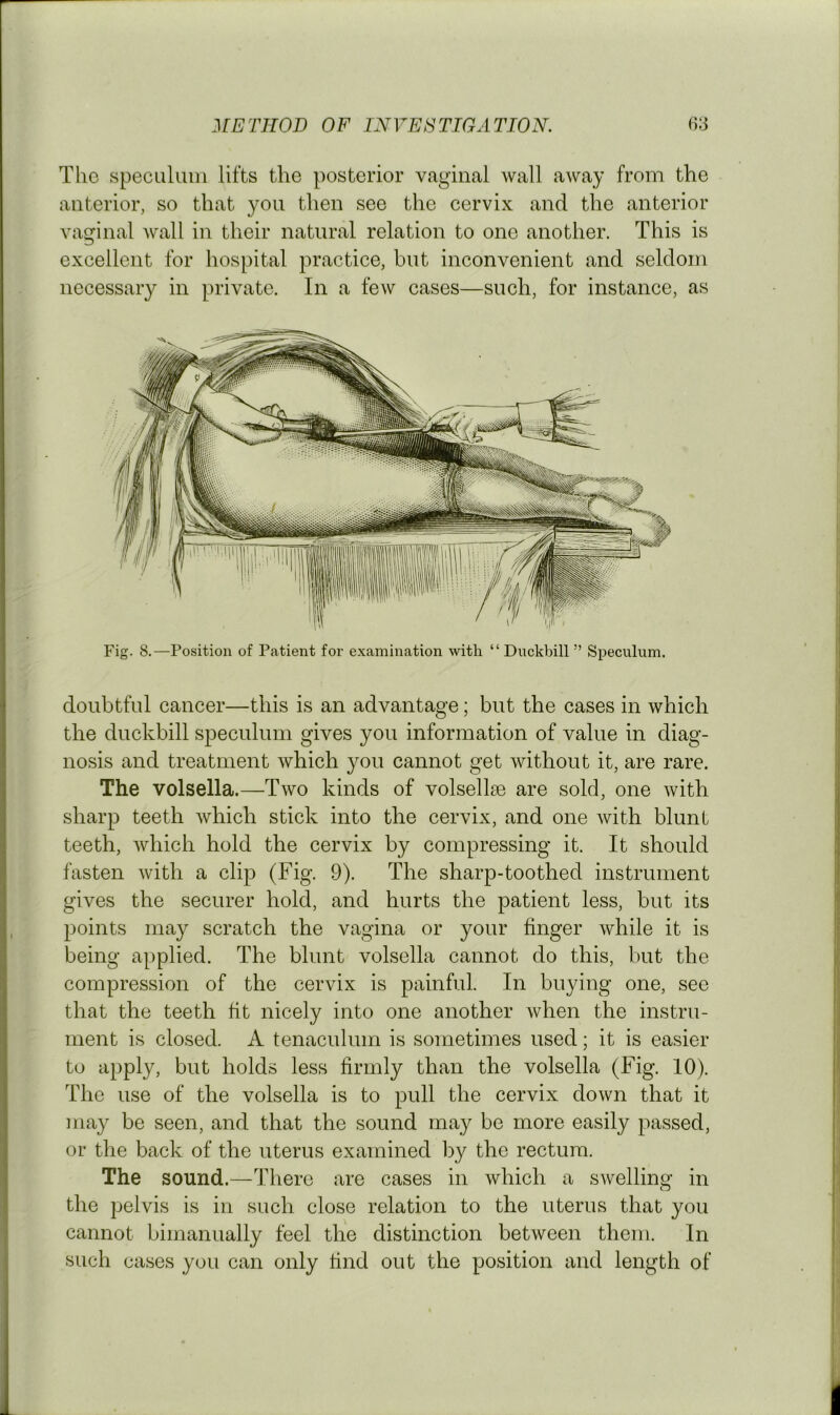 The specaliiin lifts the posterior vaginal wall away from the anterior, so that you then see the cervix and the anterior vaginal Avail in their natural relation to one another. This is excellent for hospital practice, but inconvenient and seldom necessary in private. In a few cases—such, for instance, as Fig. 8.—Position of Patient for examination with “ Duckbill ” Speculum. doubtful cancer—this is an advantage; but the cases in which the duckbill speculum gives you information of value in diag- nosis and treatment Avhich you cannot get without it, are rare. The volsella.—Two kinds of volsellse are sold, one Avith sharp teeth Avhich stick into the cervix, and one Avith blunt teeth, Avhich hold the cervix by compressing it. It should fasten Avith a clip (Fig. 9). The sharp-toothed instrument gives the securer hold, and hurts the patient less, but its points may scratch the vagina or your finger Avhile it is being applied. The blunt volsella cannot do this, but the compression of the cervix is painful. In buying one, see that the teeth tit nicely into one another Avhen the instru- ment is closed. A tenaculum is sometimes used; it is easier to apply, but holds less firmly than the volsella (Fig. 10). The use of the volsella is to pull the cervix doAvn that it may be seen, and that the sound may be more easily passed, or the back of the uterus examined by the rectum. The sound.—There are cases in Avhich a SAvelling in the pelvis is in such close relation to the uterus that you cannot bimanually feel the distinction between them. In such cases you can only find out the position and length of