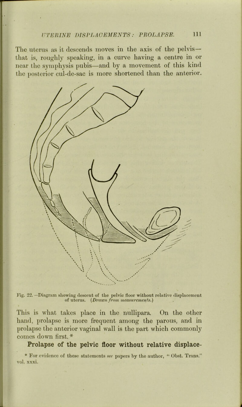 The uterus iis it descends moves in the axis of the pelvis— that is, roughly speaking, in a curve having a centre in or near the symphysis pubis—and by a movement of this kind the posterior cul-de-sac is more shortened than the anterior. Fig. 22. —Diagram showing descent of the pelvic floor without relative displacement of uterus. {Drawn from measurements.) \ This is what takes place in the nullipara. On the other hand, prolapse is more frequent among the parous, and in prolapse the anterior vaginal wall is the part which commonly comes down first. * Prolapse of the pelvic floor without relative displace- * For evidence of these statements see papers hy the aiithor, “ Ohst. Trans.” vol. xxxi.