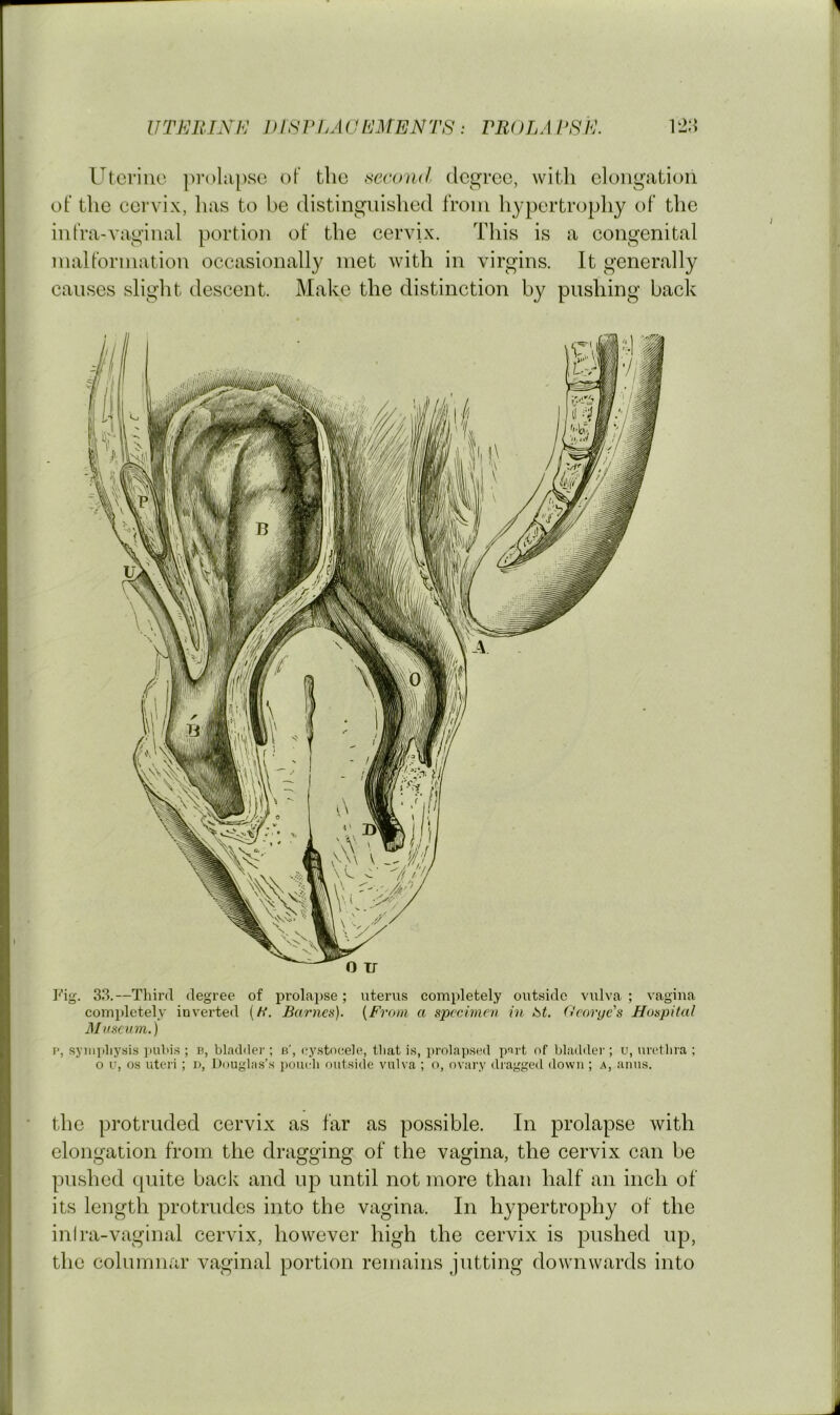 IITJ^JELYH J)ISrhACI<JMENTS: rROLAESE. Uterine prolapse of the second degree, with elongation of the cervix, has to he distinguished from hypertrophy of the infra-vaginal portion of the cervix. This is a congenital malformation occasionally met Avith in virgins. It generally causes slight descent. Make the distinction by pushing back Fig. 33.—Third degree of prolai>se; uterus completely outside vulva ; vagiua completely inverted (//. Barnes). [From a specimen in St. fieorge's Hospital Museum.) V, syiiipliysis jmbis ; n, bladder ; b', eystocele, that is, prolapsed part of bladder ; u, urelbra ; o u, os uteri ; v, Douglas’s i)oucb outside vulva ; o, ovary dragged down ; a, anus. the protruded cervix as far as possible. In prolapse with elongation from the dragging of the vagina, the cervix can be pushed quite back and up until not more than half an inch of its length protrudes into the vagina. In hypertrophy of the inira-vaginal cervix, however high the cervix is pushed up, the columnar vaginal portion remains jutting downwards into J