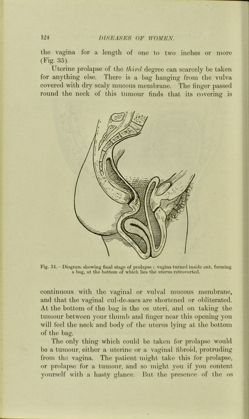 the vagina for a length of one to two inches or more (Fig. 35). Uterine prolapse of the third degree can scarcely be taken for anything else. There is a bag hanging from the vulva covered with dry scaly mucous membrane. The finger passed round the neck of this tumour finds that its covering is O Fig. 31.—Diagram shoAving final stage of prolapse : vagina turned inside out, forming a bag, at the bottom of which lies the uterus retroverted. continuous with the vaginal or vulval mucous membrane, and that the vaginal cul-de-sacs are shortened or obliterated. At the bottom of the bag is the os uteri, and on taking the tumour between your thumb and finger near this opening you will feel the neck and body of the uterus lying at the bottom of the bag. The only thing which could be taken for prolapse would be a tumour, either a uterine or a vaginal fibroid, protruding from the vagina. The patient might take this for prolapse, or prolapse for a tumour, and so might you if you content 3'ourself with a hasty glance. Hut the presence of the os