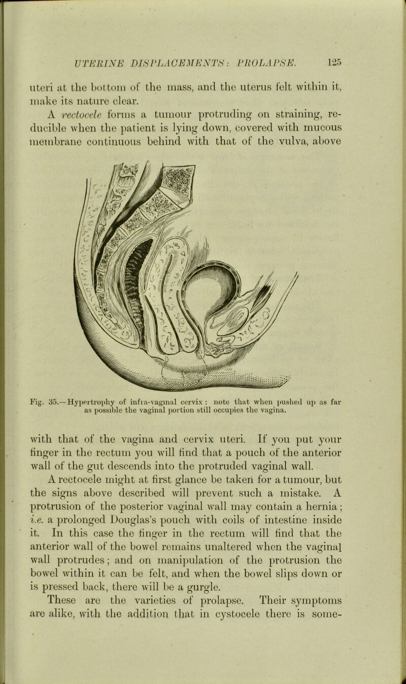 uteri at the bottom of the mass, and the uterus felt within it, make its nature clear. A rectocele forms a tumour protruding on straining, re- ducible when the patient is lying down, covered with mucous membrane continuous behind with that of the vulva, above Fig. 35.—Hyppi'trophy of infi.a-vaginal cervix : note that when pushed up as far as possible the vaginal portion still occupies the vagina. Avith that of the vagina and cervix uteri. If you put your finger in the rectum you will find that a pouch of the anterior Avail of the gut descends into the protruded vaginal wall. A rectocele might at first glance be taken for a tumour, but the signs above described Avill prevent such a mistake. A protrusion of the posterior vaginal Avail may contain a hernia; i.e. a prolonged Douglas’s pouch Avith coils of intestine inside it. In this case the finger in the rectum Avill find that the anterior Avail of the bowel remains unaltered Avhen the vaginal Avail protrudes; and on manijAulation of the protrusion the bowel Avithin it can be felt, and Avhen the boAvel slips doAvn or is pressed back, there Avill be a gurgle. These are the varieties of prolapse. Their symptoms are alike, with the addition that in cystocele there is some-