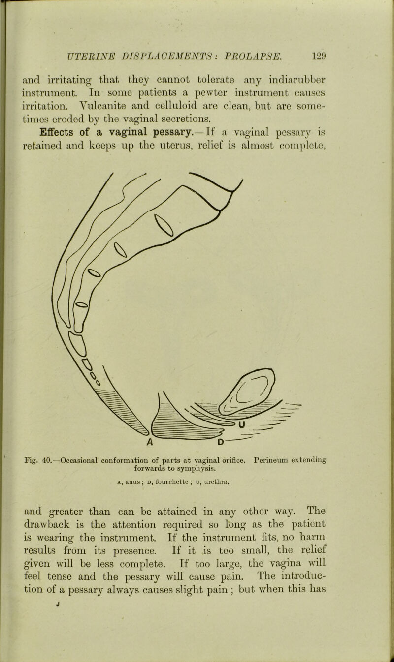 and irritating that they cannot tolerate any indiarubber instrument. In some patients a pewter instrument causes irritation. Vulcanite and celluloid are clean, but are some- times eroded by the vaginal secretions. Effects of a vaginal pessary.— If a vaginal pessary is retained and keeps up the uterus, relief is almost conpdete, Fig. 40.—Occasional conformation of parts at vaginal orifice. Perineum extending forwards to symphysis. A, anus ; n, fourchette ; u, urethra. and greater than can be attained in any other way. The drawback is the attention required so long as the patient is wearing the instrument. If the instrument fits, no harm results from its presence. If it is too small, the relief given will be less complete. If too large, the vagina will feel tense and the pessary will cause pain. The introduc- tion of a pessary always causes slight pain ; but when this has