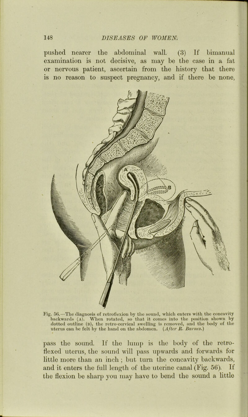 pushed nearer the abdominal wall. (3) If bimanual examination is not decisive, as may be the case in a fat or nervous patient, ascertain from the history that there is no reason to susj)ect pregnancy, and if there be none, Fig. 5().—The diagnosis of retrollexion hy the sound, Avhich enters with the concavity backwards (a). When rotated, so tluit it comes into the position sliown by dotted outline (b), the retro-cervical swelling is removed, and the body of the uterus can be felt by the hand on the abdomen. {After R. Barnes.) pass the sound. If the luni[) is the body of the retro- Hexed uterus, the sound will pass upwards and forwards for little more than an inch ; but turn the concavity backwards, and it enters the full length of the uterine canal (Fig. 56). If the flexion be sharp you may have to bend the sound a little